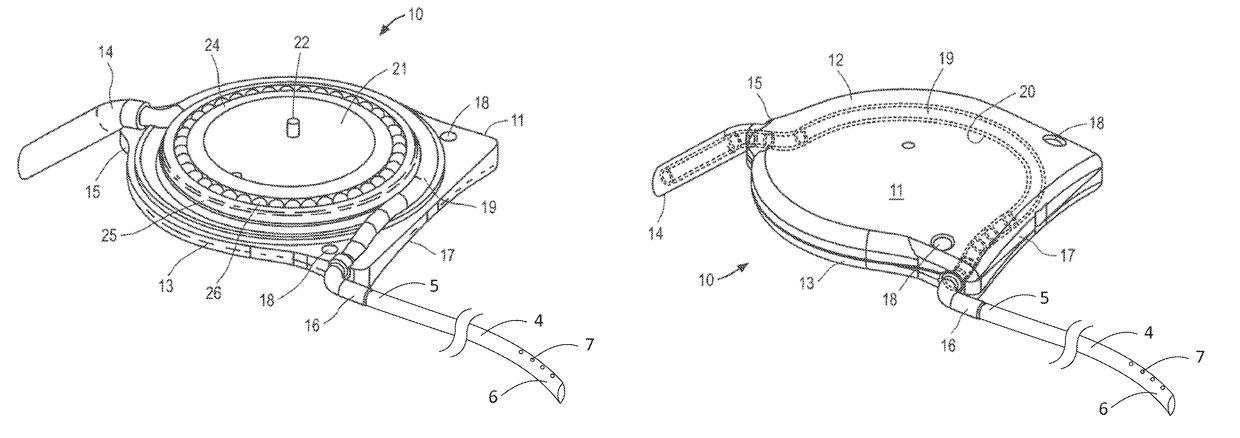 Apparatus and methods for treating excess intraocular fluid