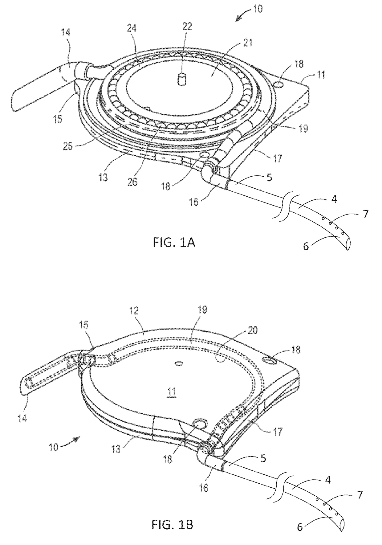 Apparatus and methods for treating excess intraocular fluid