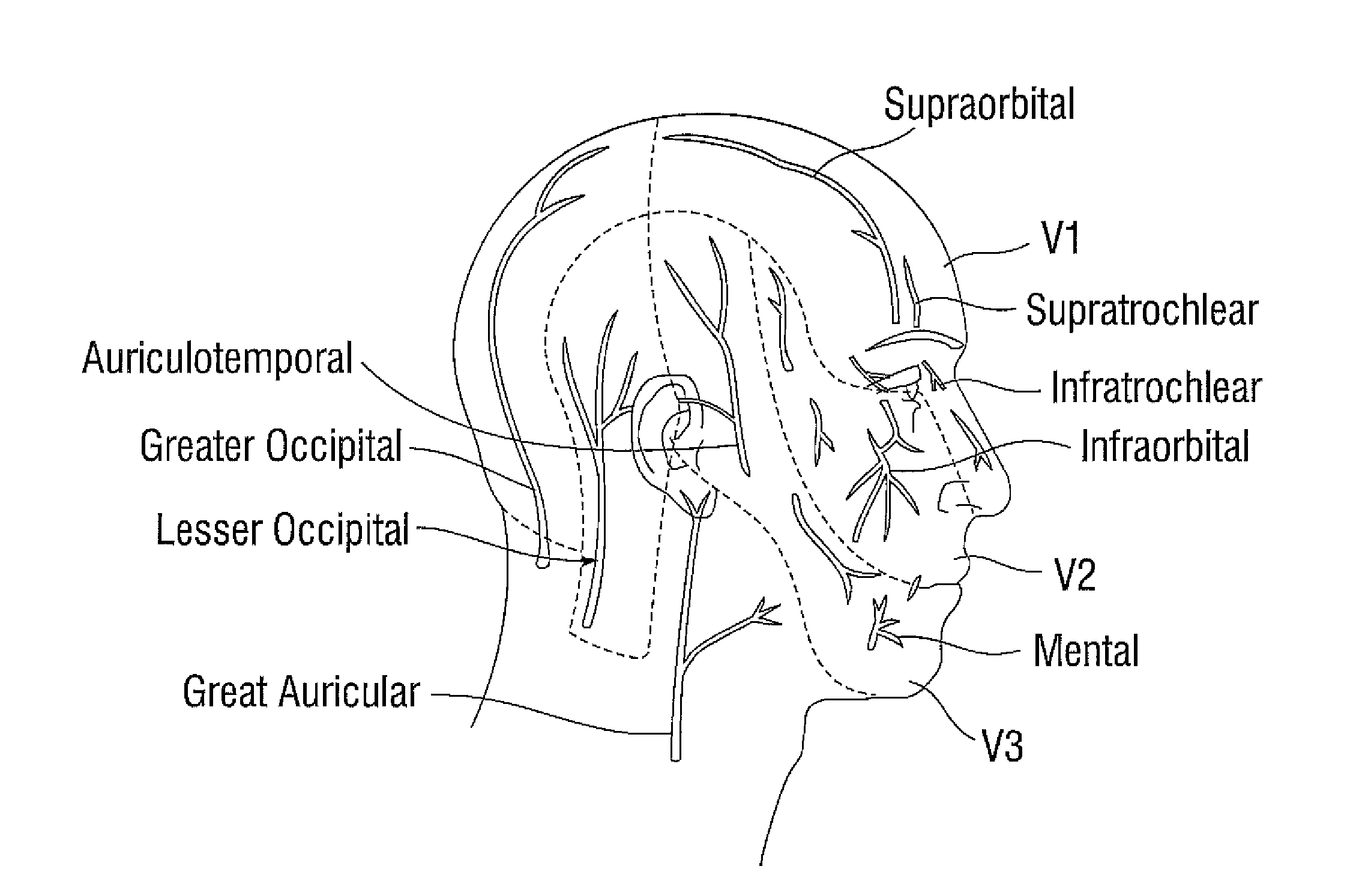 Treatment of migraine headache with diffusion of toxin in non-muscle related foraminal sites