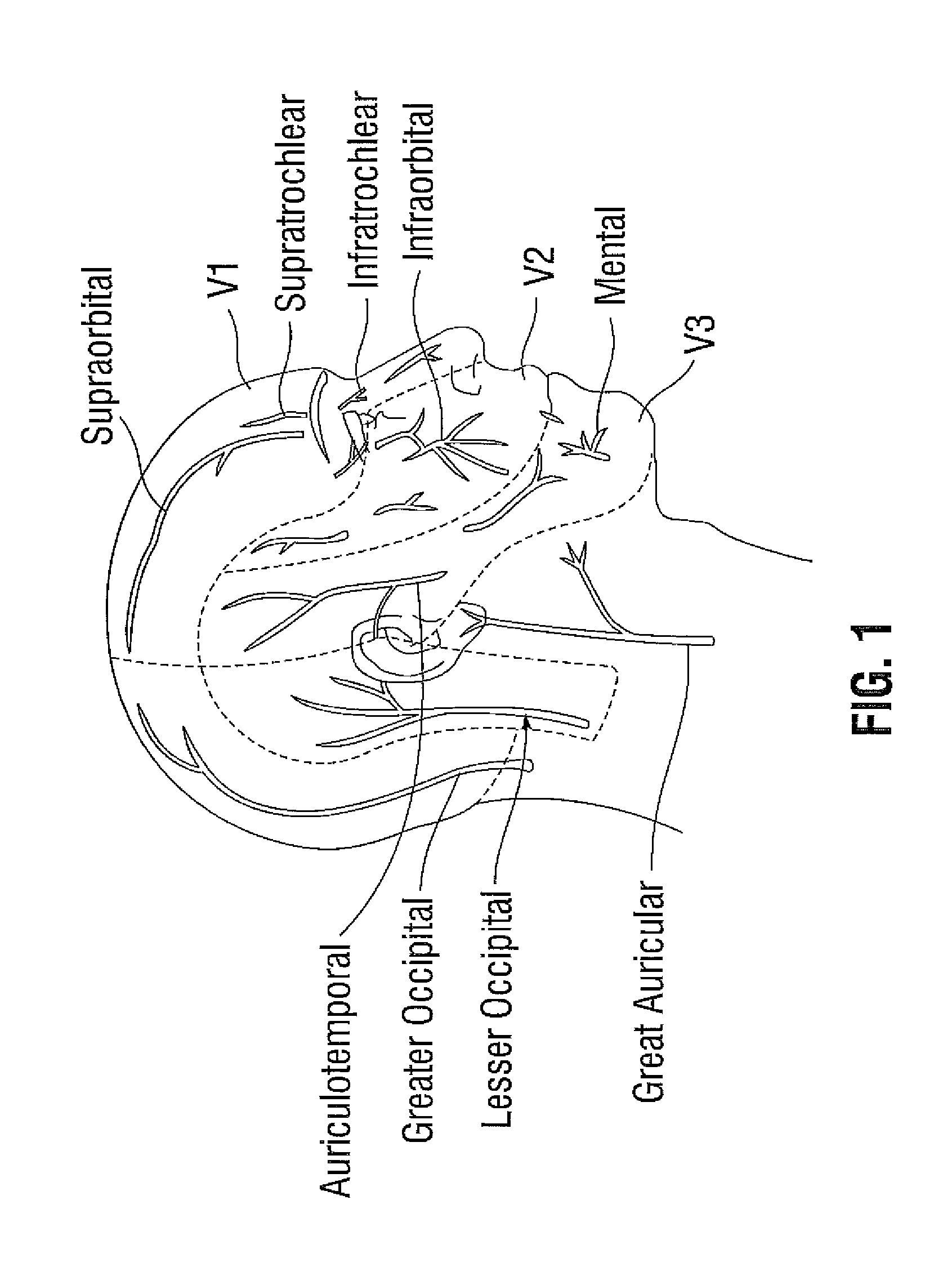 Treatment of migraine headache with diffusion of toxin in non-muscle related foraminal sites