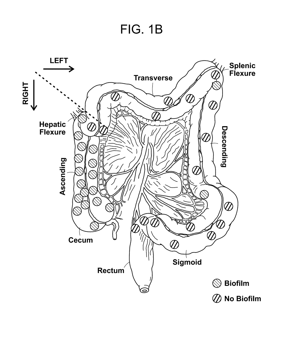 Biofilm formation to define risk for colon cancer