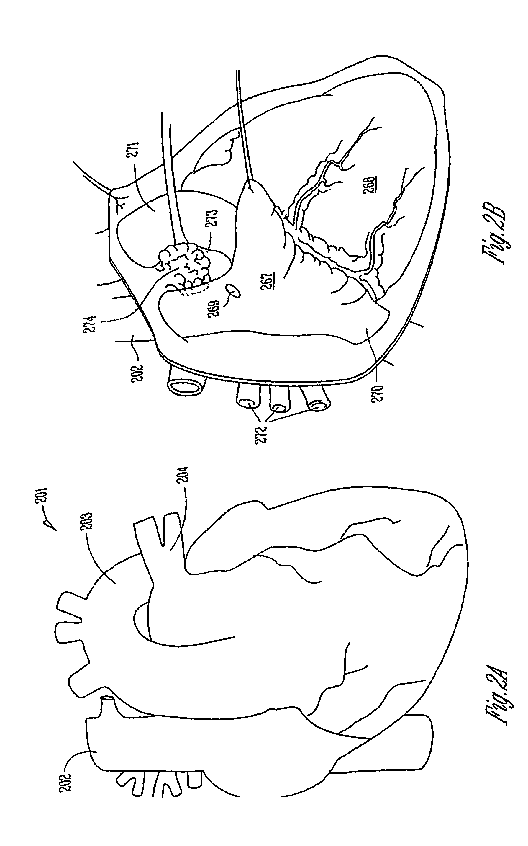 Adaptive baroreflex stimulation therapy for disordered breathing