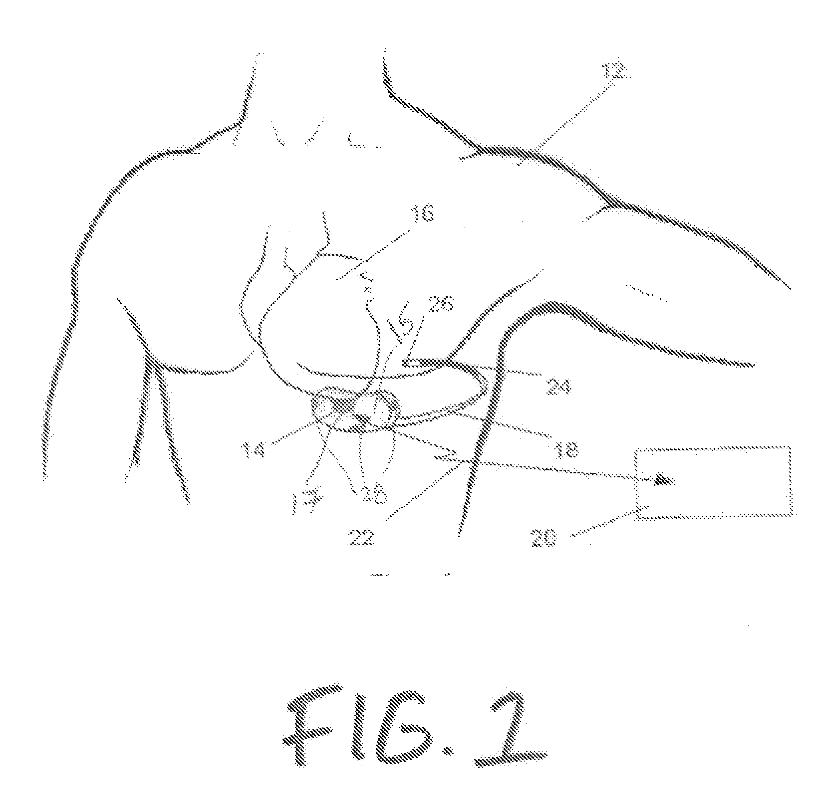 Method and apparatus for verifying a determined cardiac event in a medical device based on detected variation in hemodynamic status