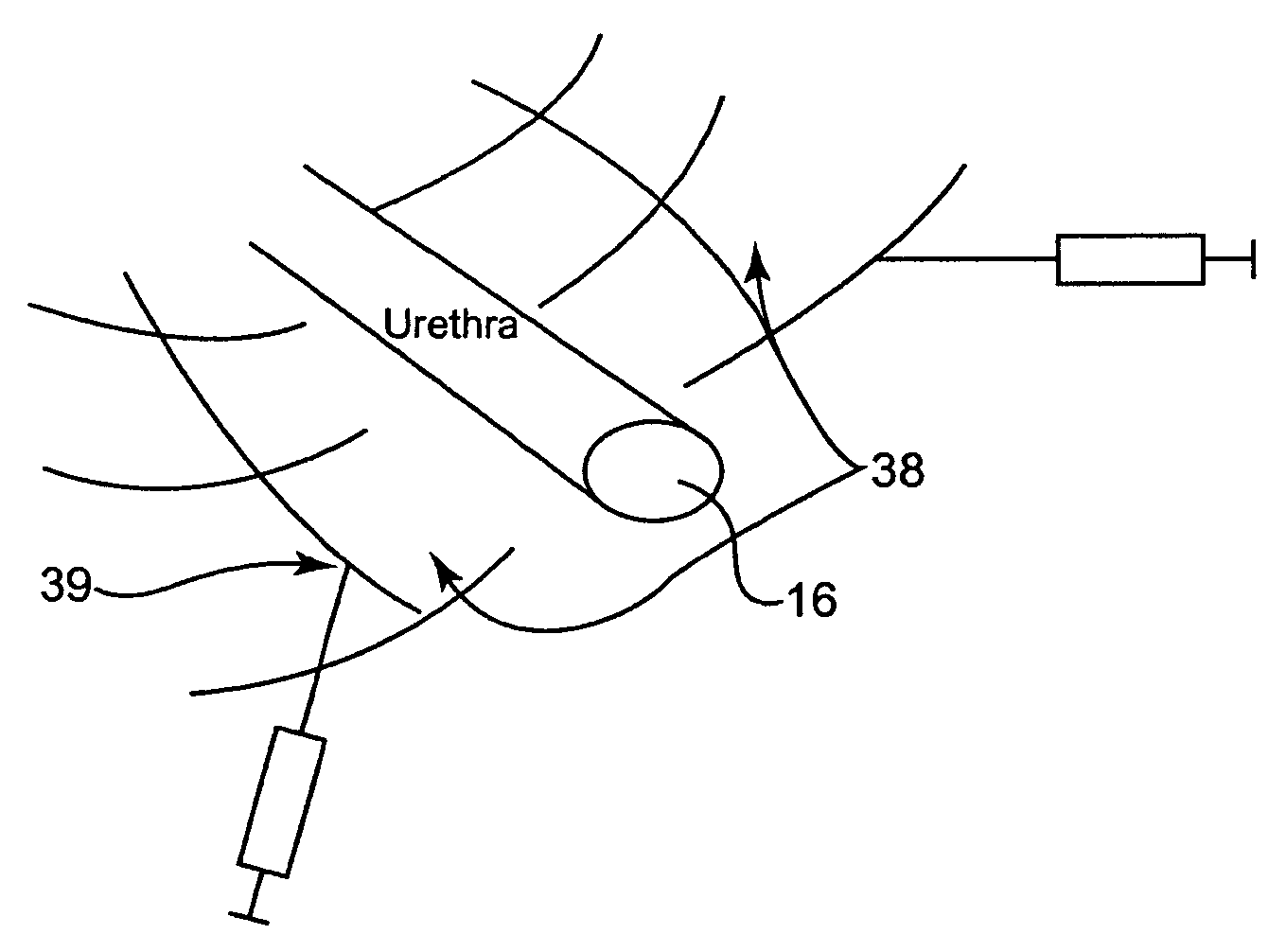 Method and articles for treatment of stress urinary incontinence