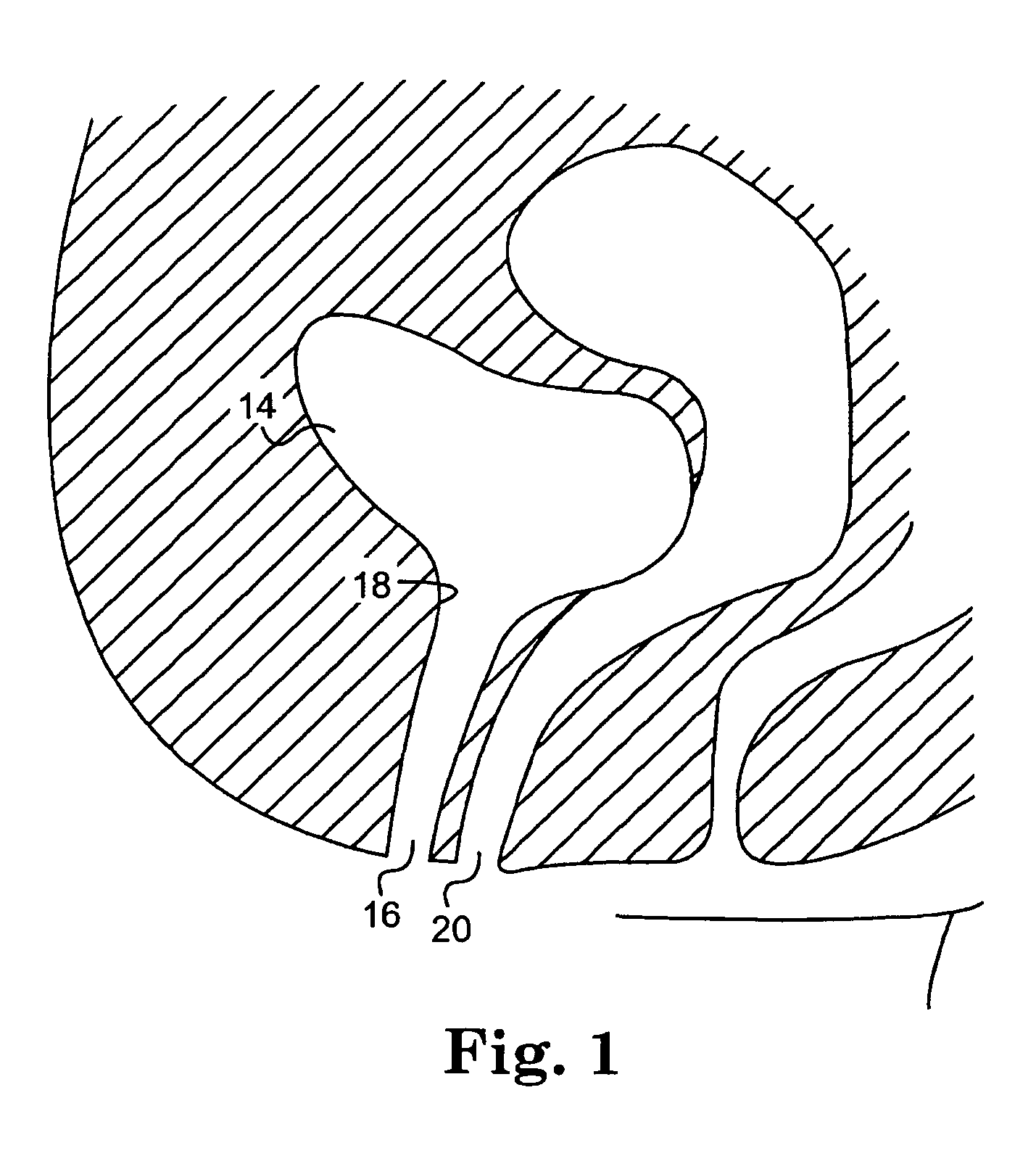 Method and articles for treatment of stress urinary incontinence