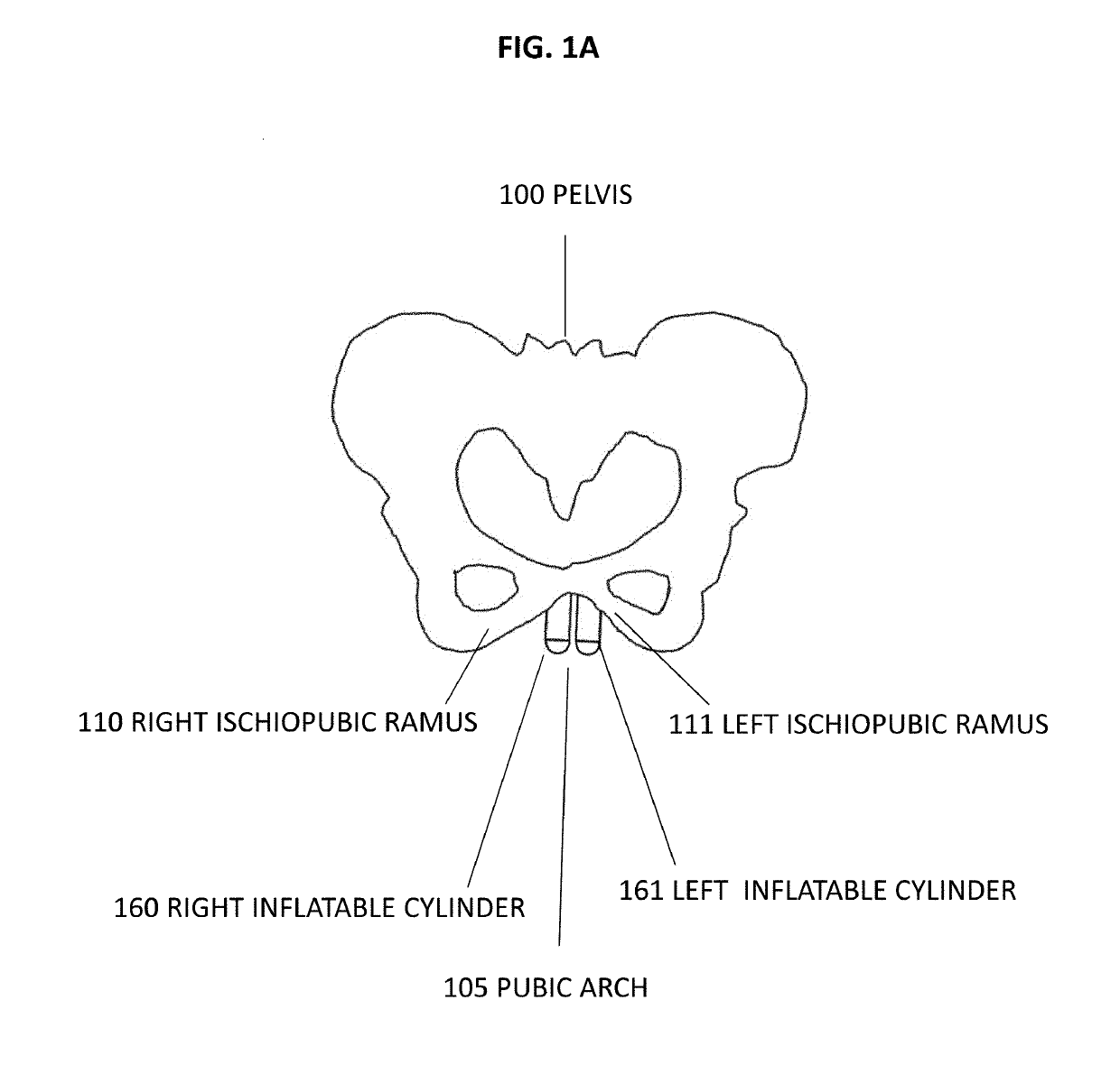 Pelvic anchor for penile prosthetic implants