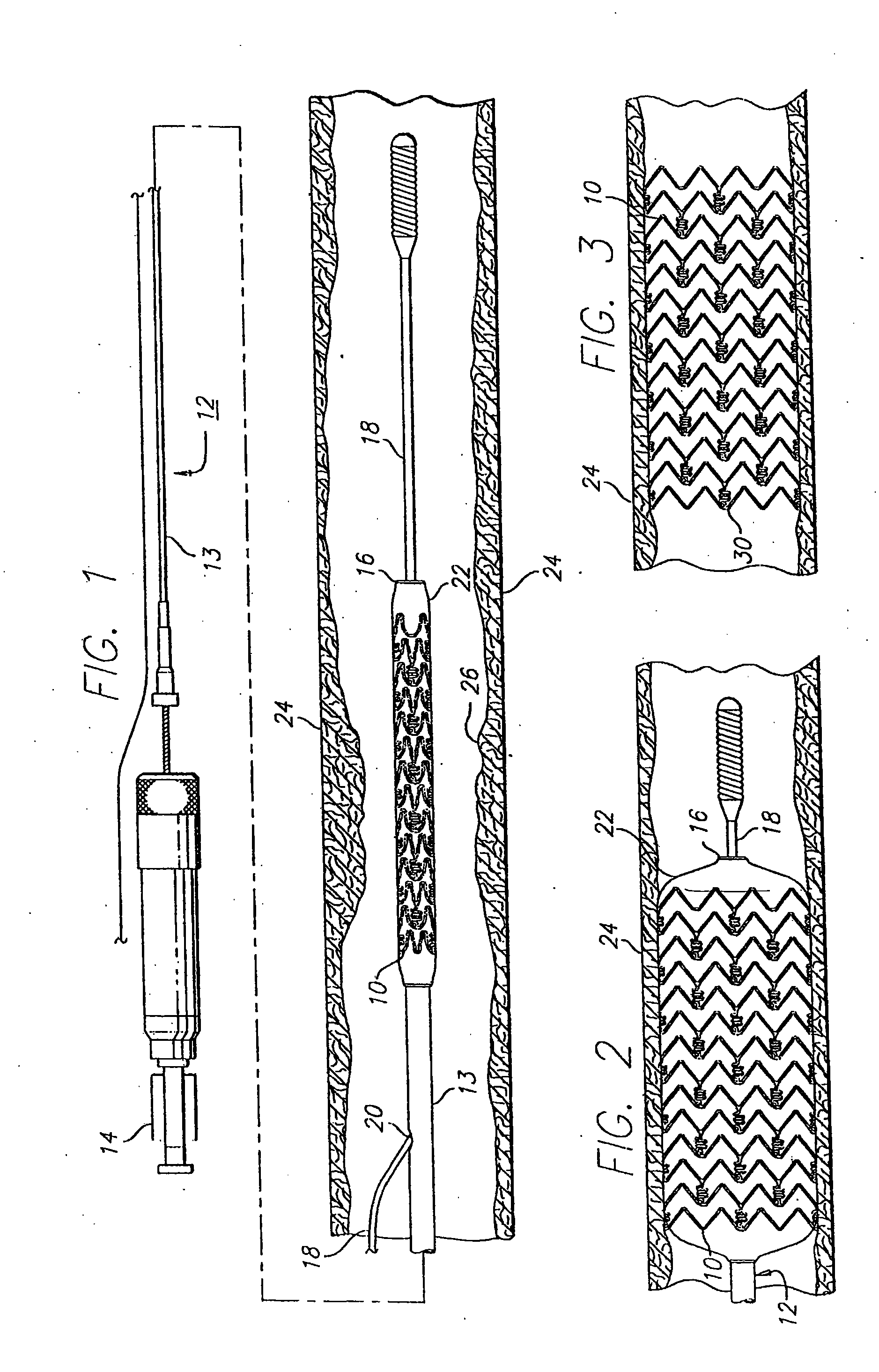 Intravascular stent