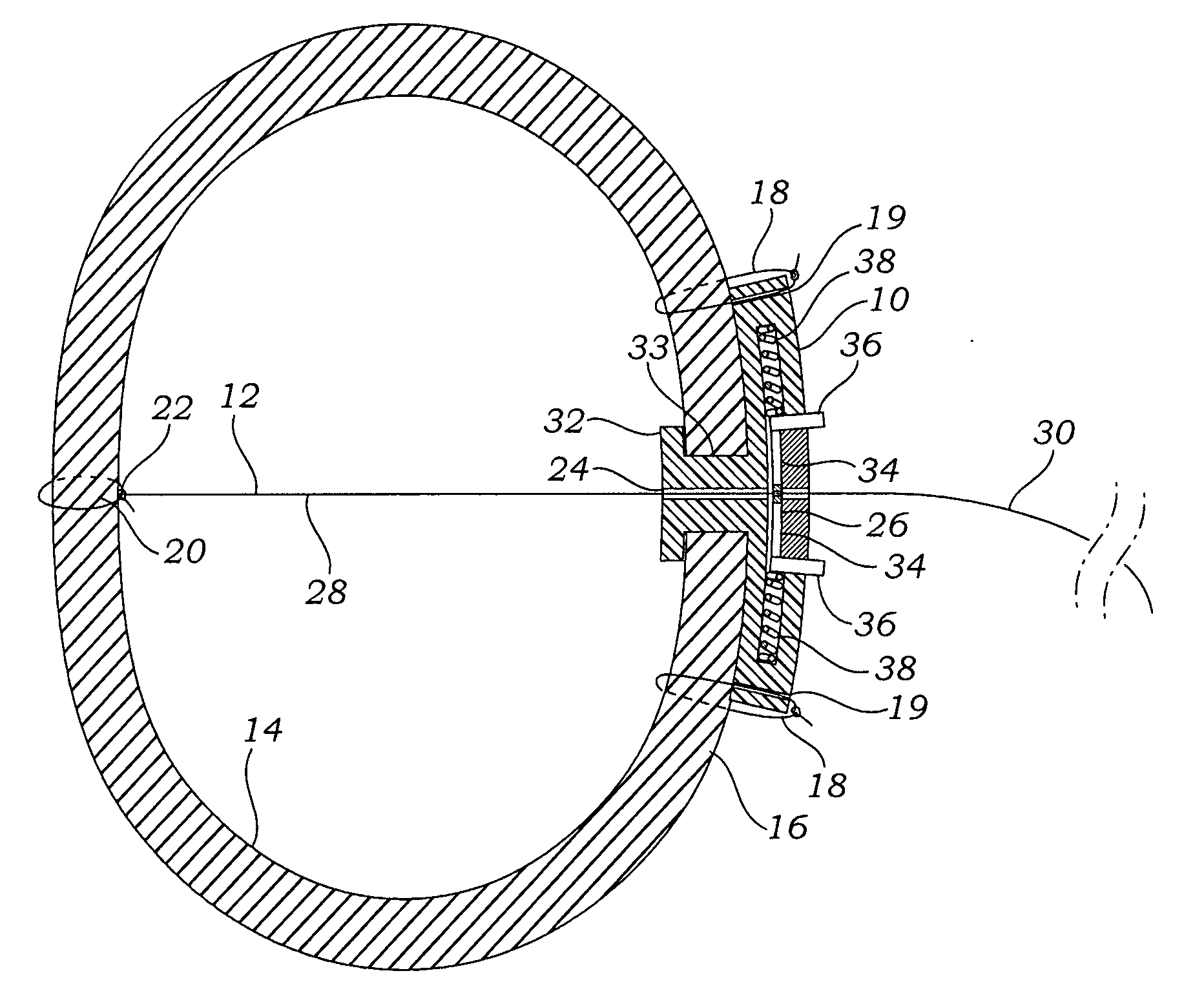 Apparatus, system, and method for applying and adjusting a tensioning element to a hollow body organ