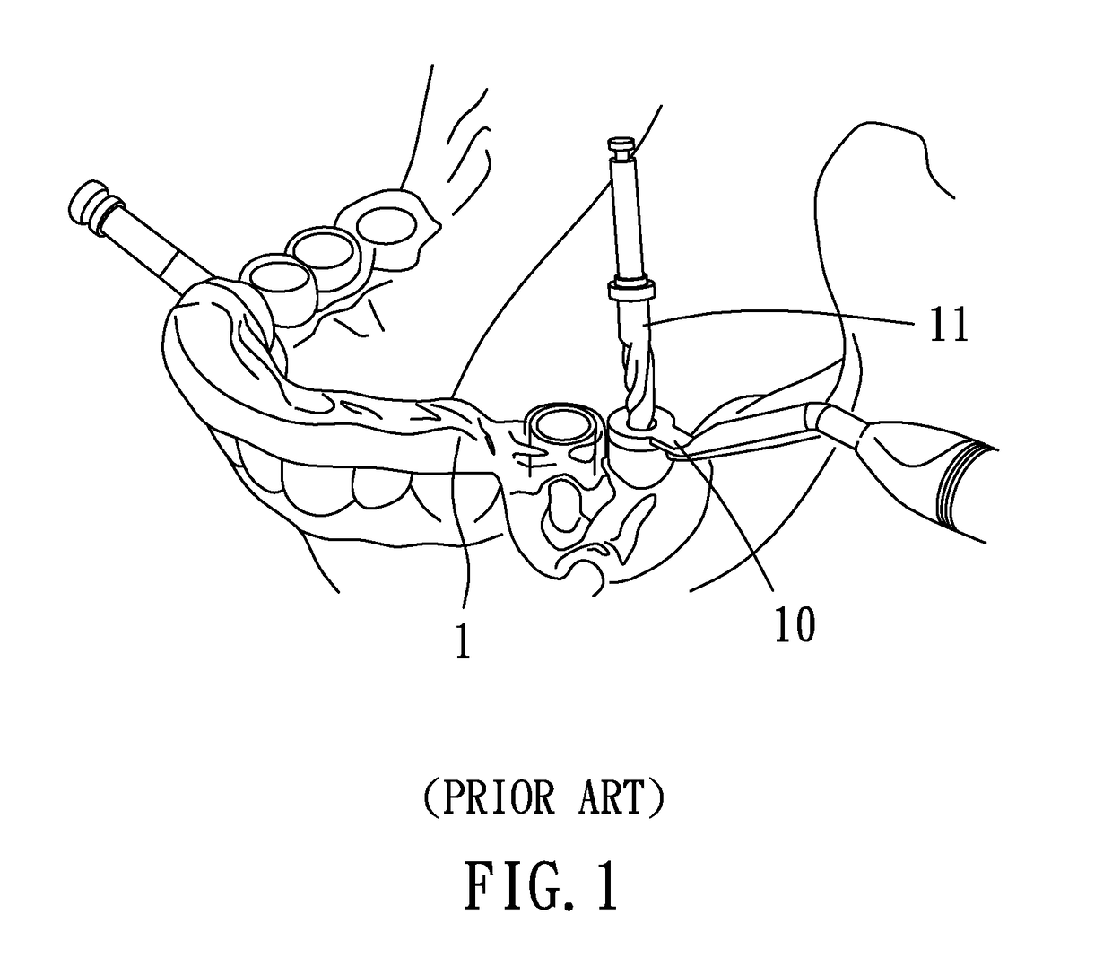 Planning and guiding method and excavation guiding device for correctly implanting artificial tooth root at predetermined site