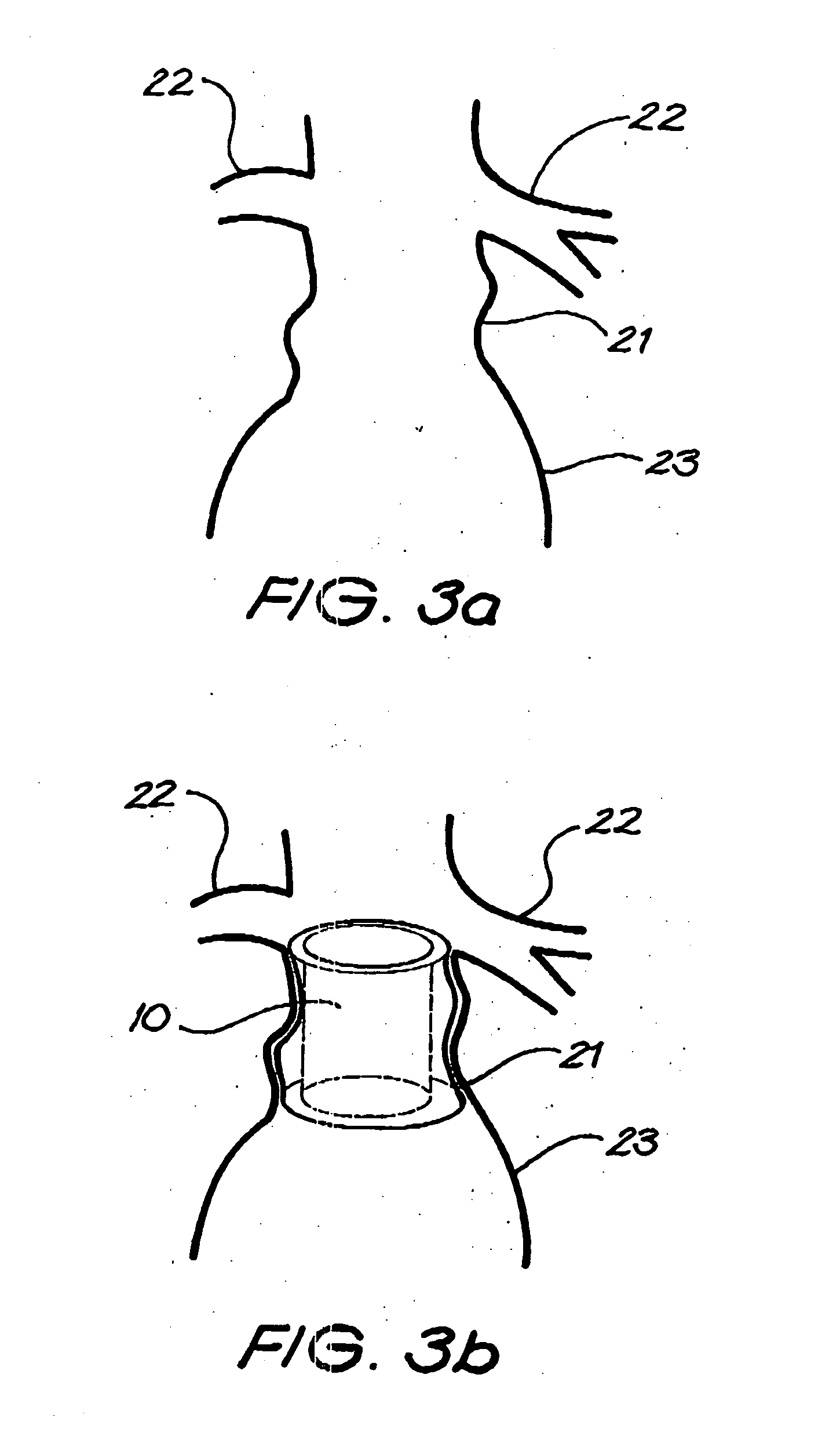 Device for use in intraluminal grafting