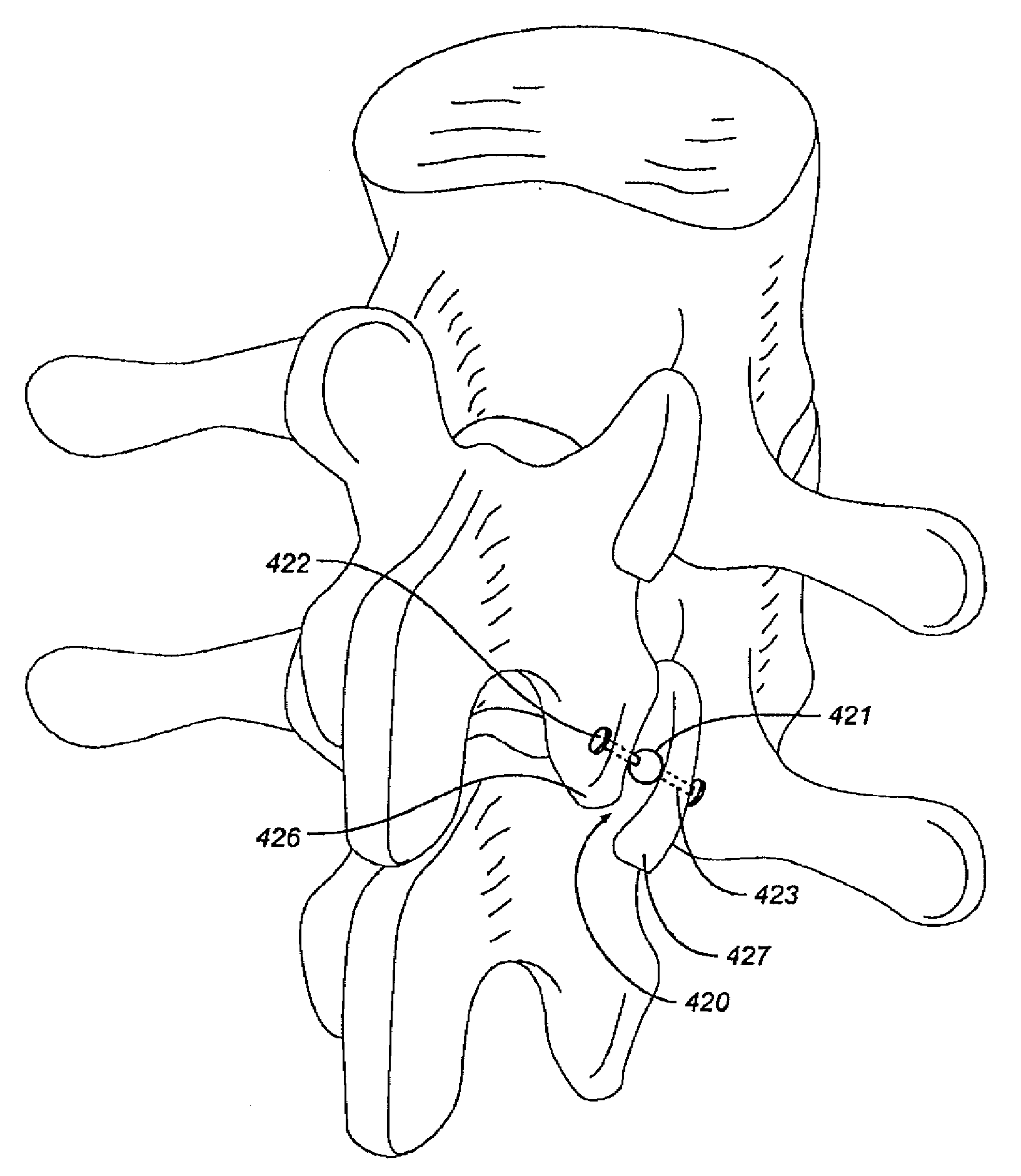 Facet device and method