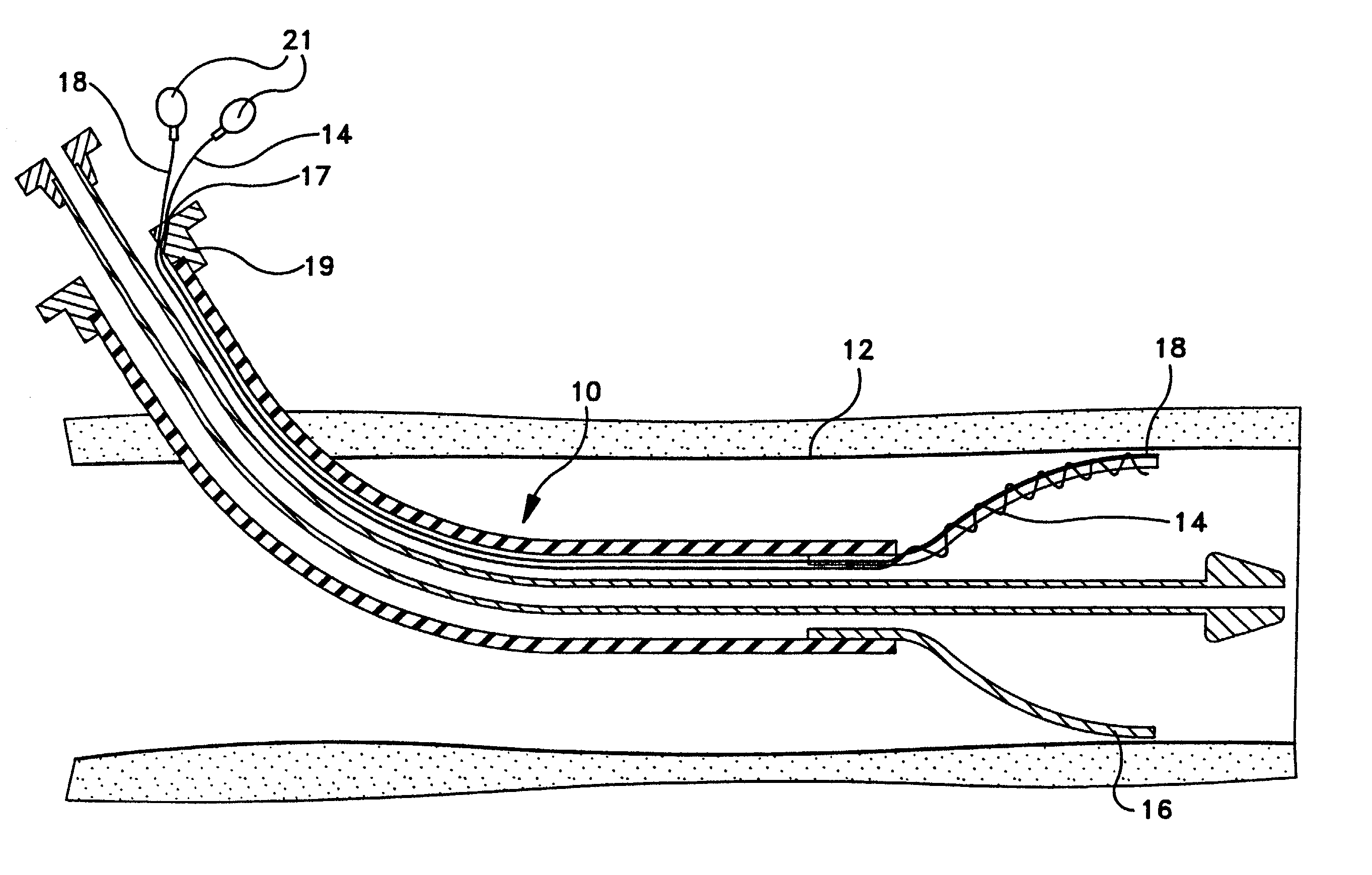 Radiopaque markers for implantable prostheses