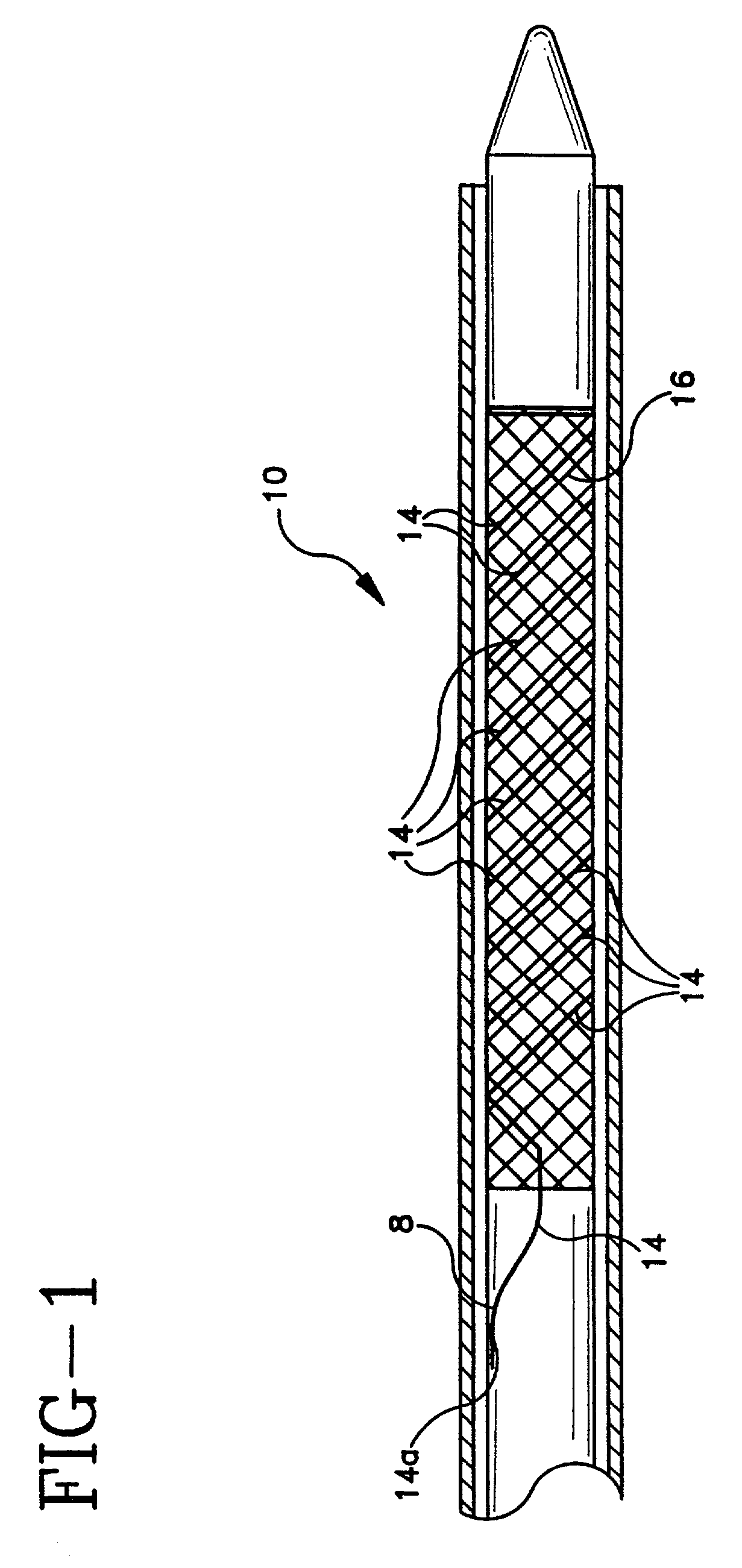 Radiopaque markers for implantable prostheses