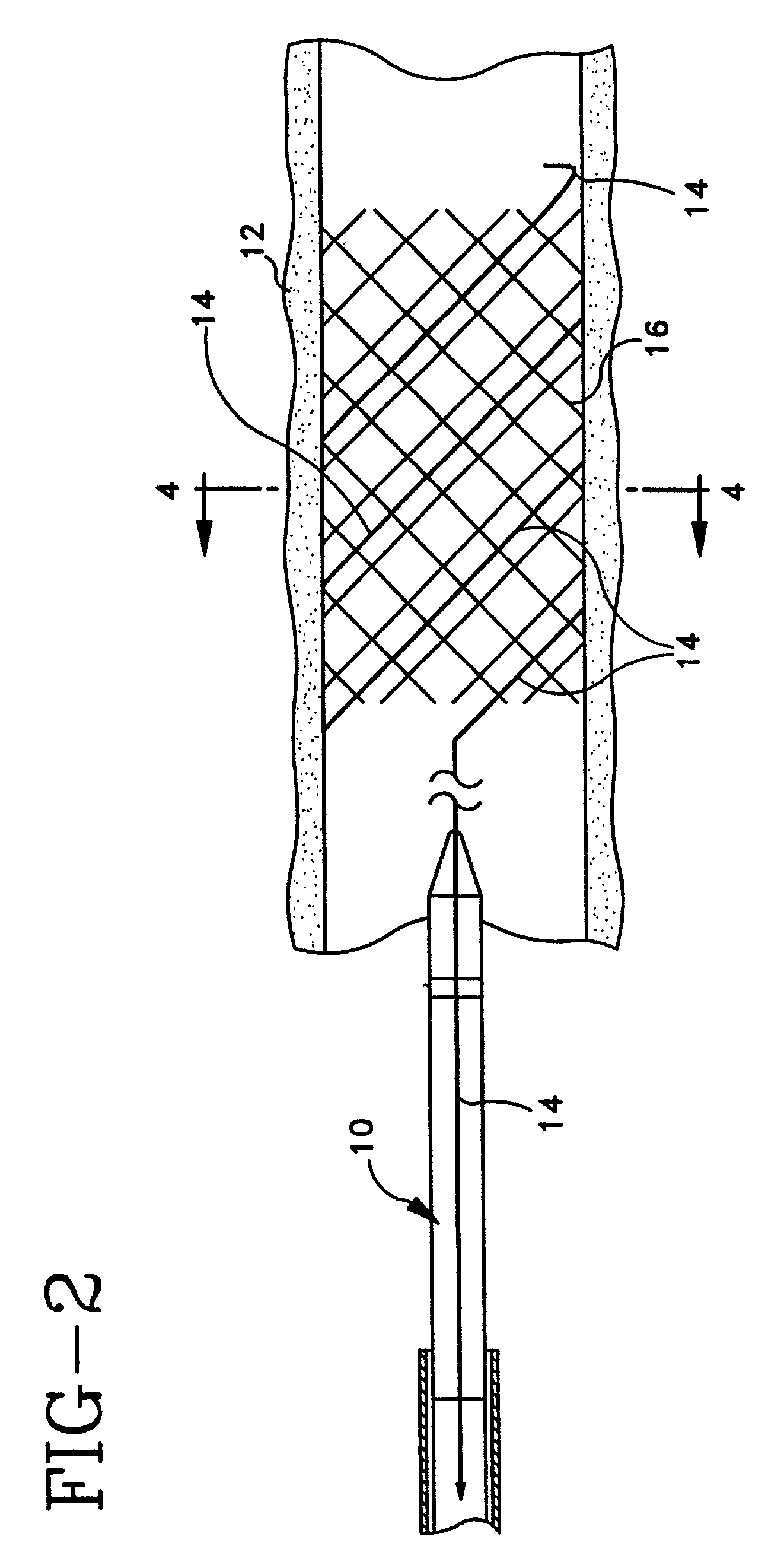 Radiopaque markers for implantable prostheses