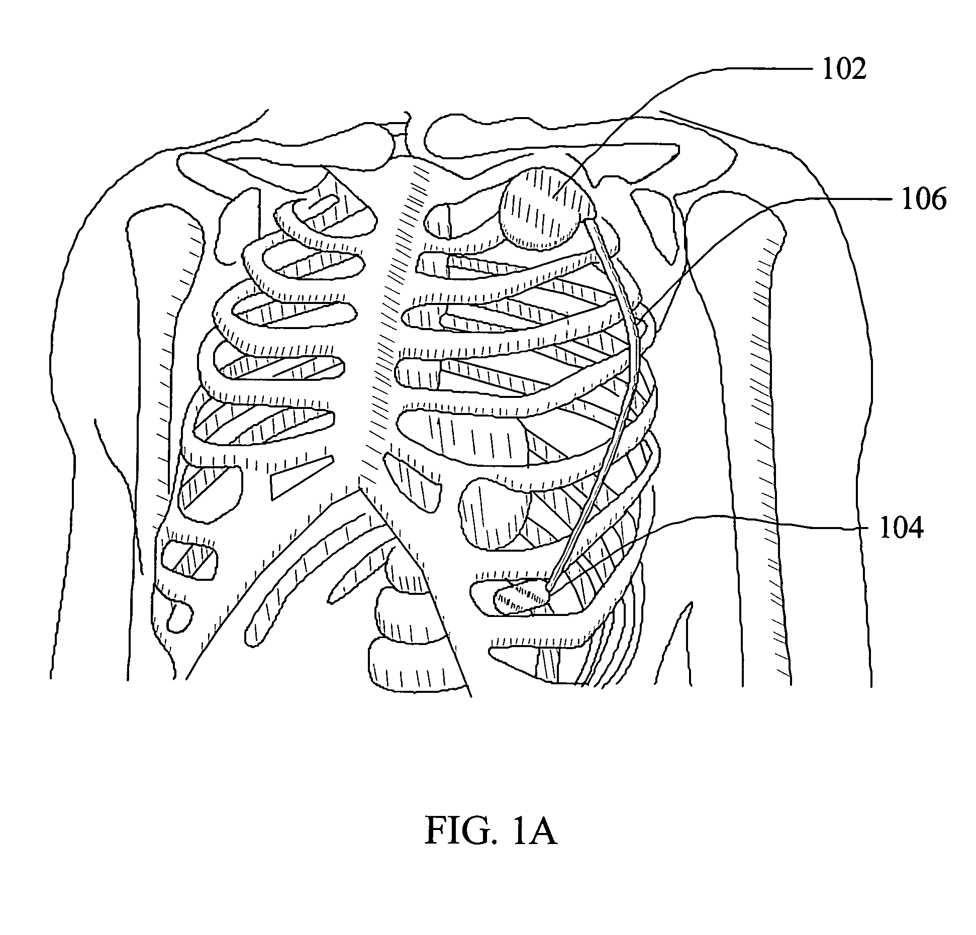 Subcutaneous electrode and lead with phoresis based pharmacological agent delivery