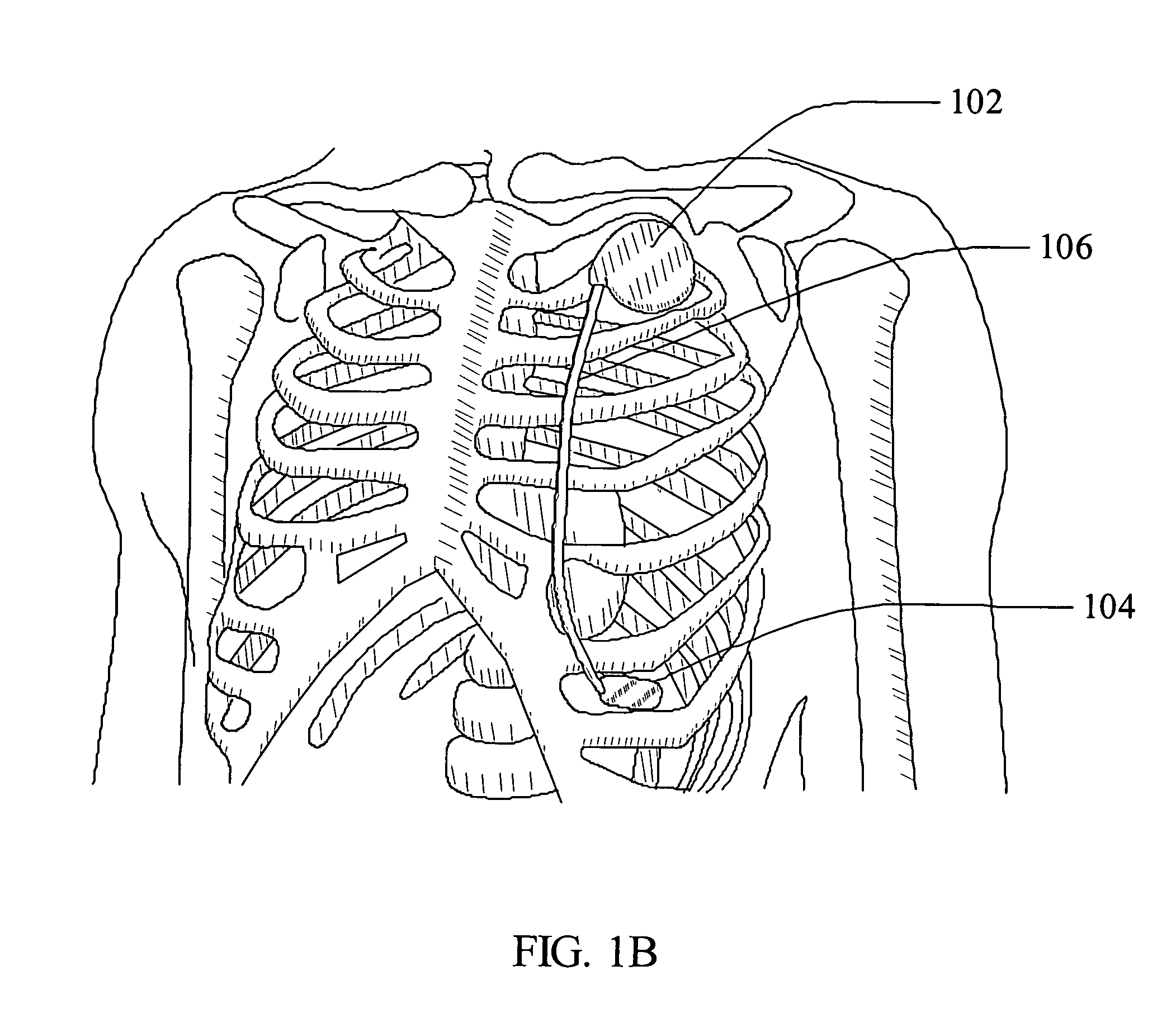 Subcutaneous electrode and lead with phoresis based pharmacological agent delivery