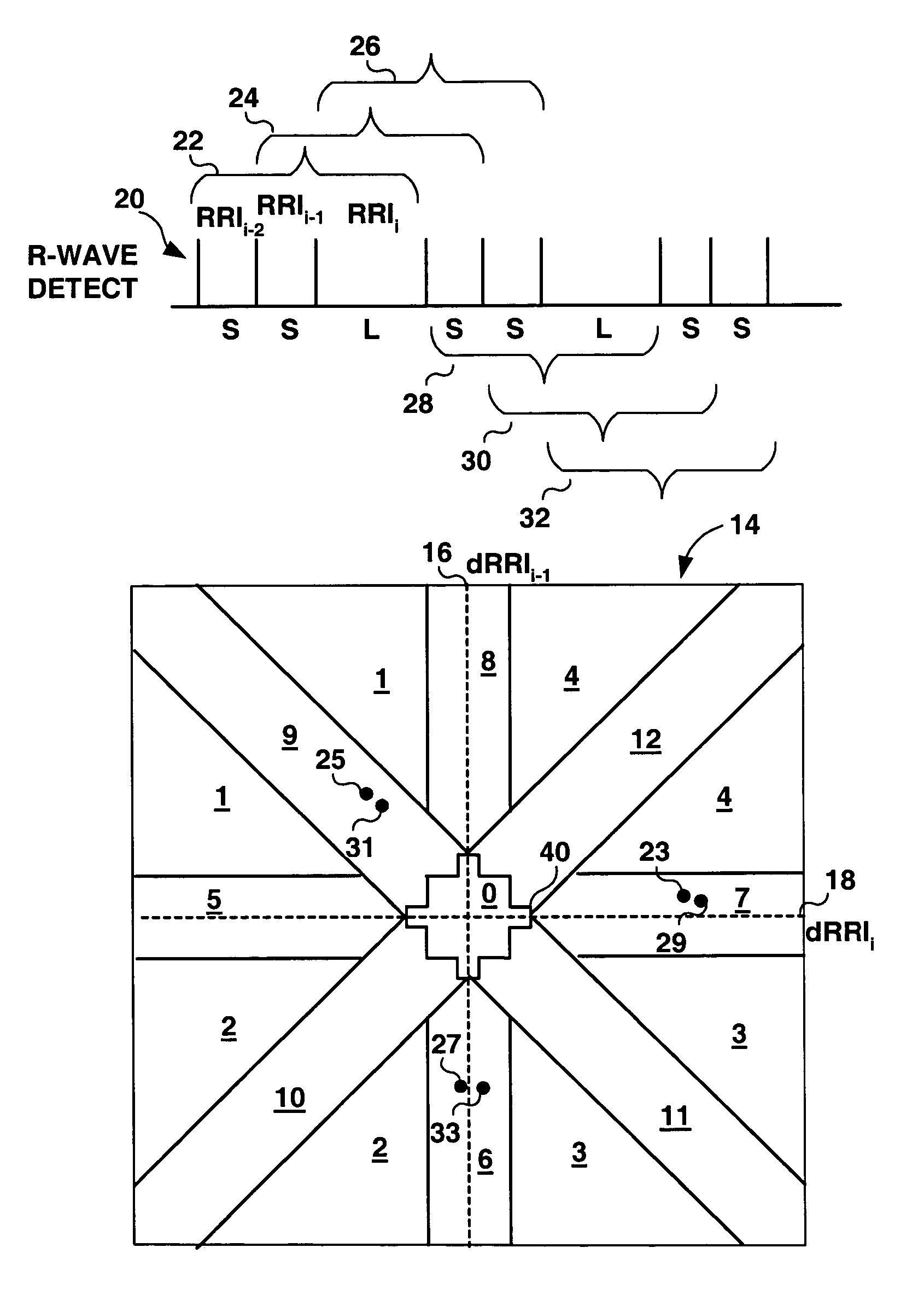 Method and apparatus for detection of tachyarrhythmia using cycle lengths