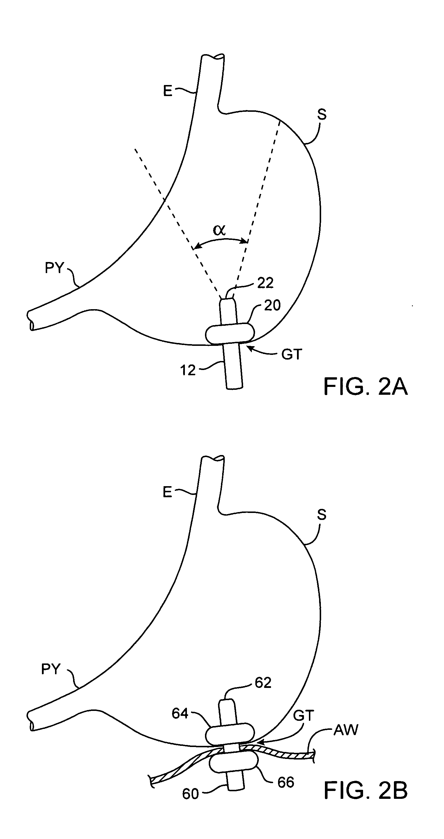 Apparatus and methods for transgastric tissue manipulation