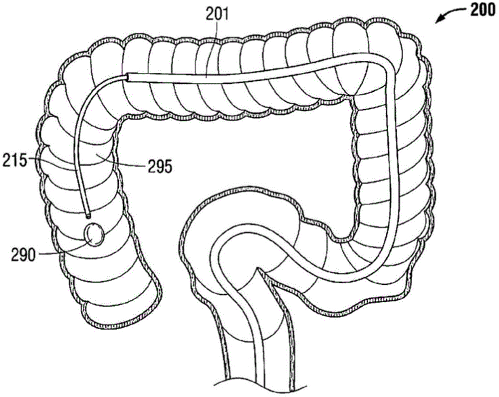 Multi-lumen-catheter retractor system for a minimally-invasive, operative gastrointestinal treatment