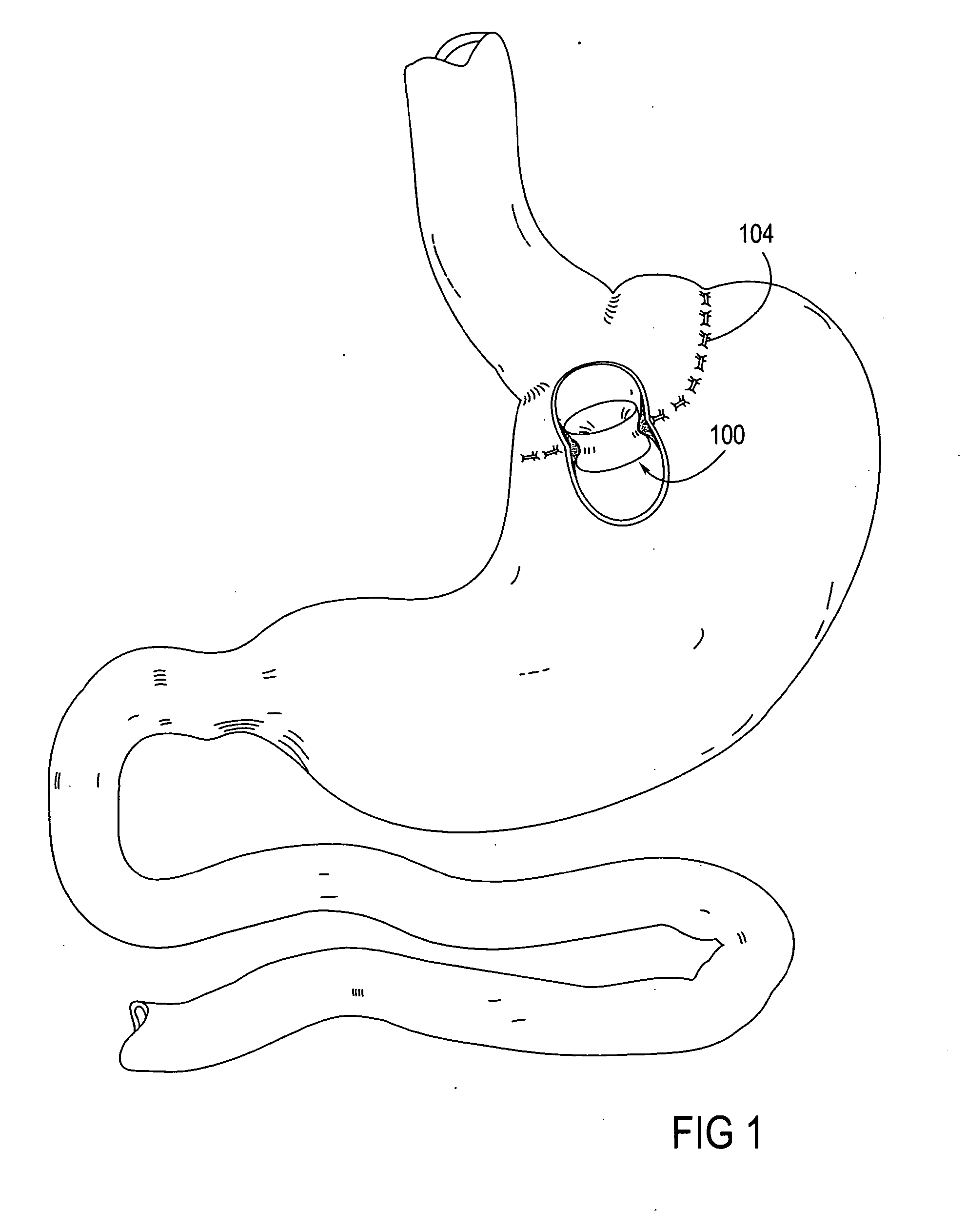 Apparatus and methods for treatment of morbid obesity