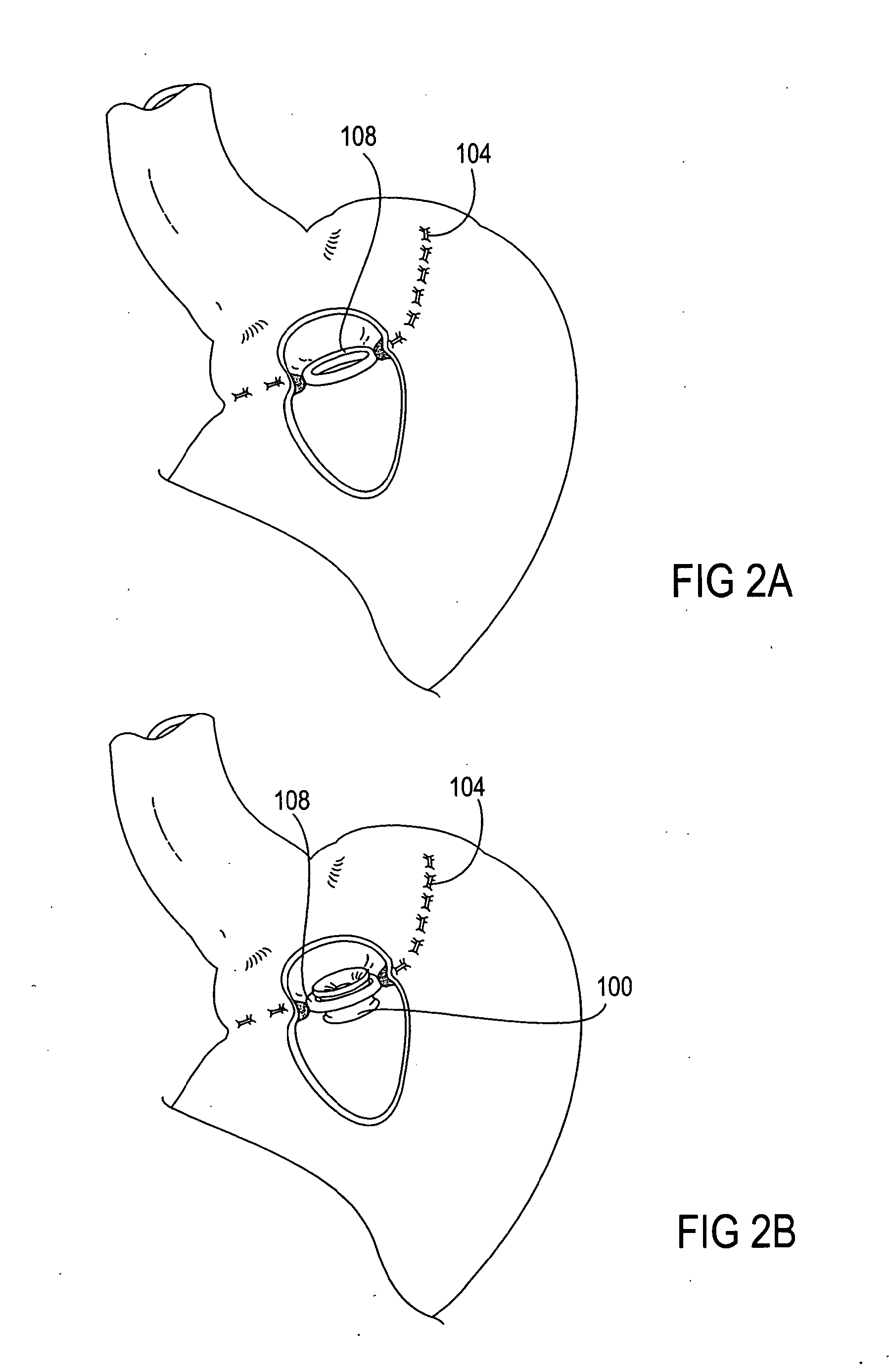 Apparatus and methods for treatment of morbid obesity