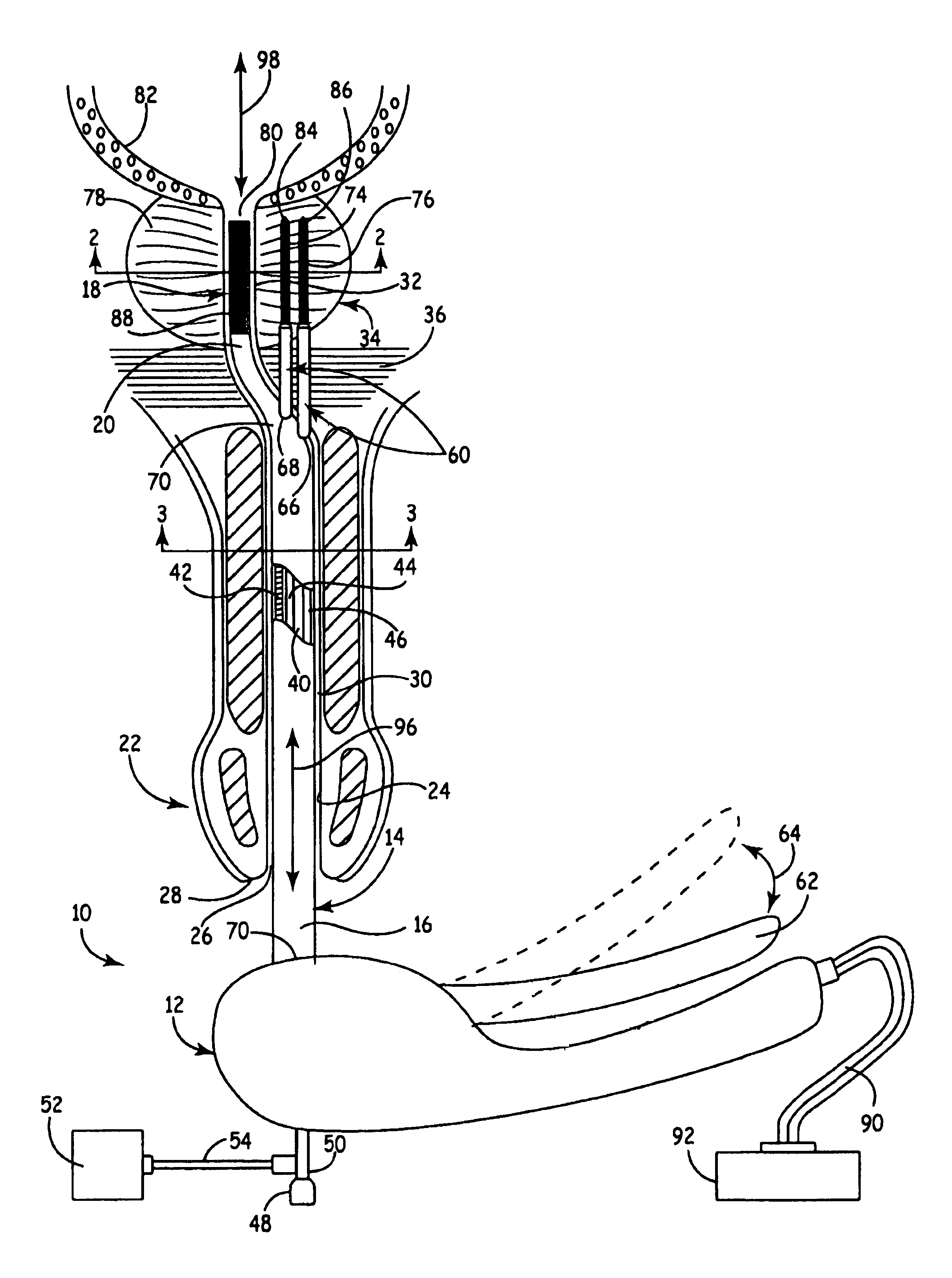 Apparatus and method for the treatment of benign prostatic hyperplasia