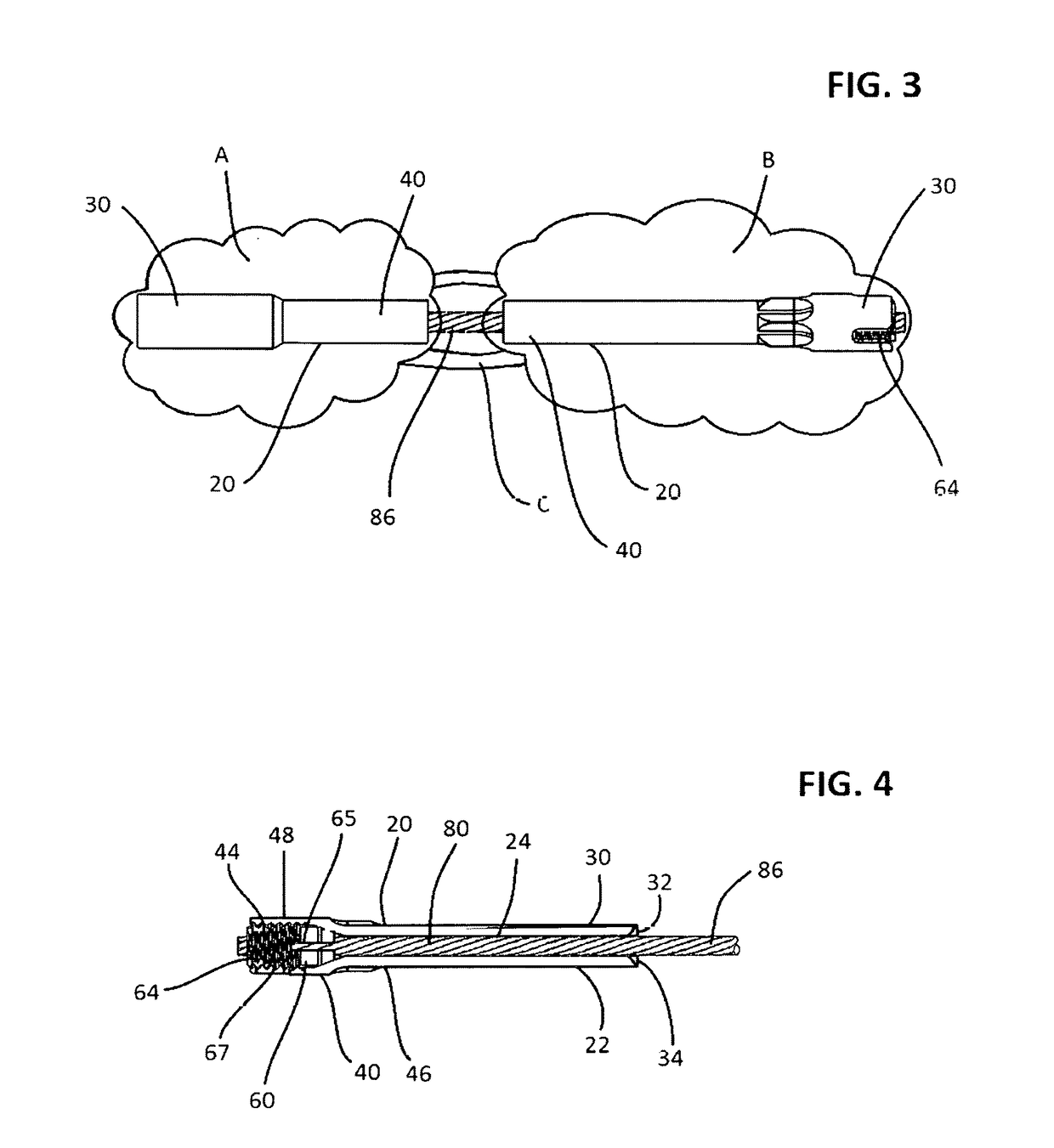 Apparatus and method for repair of disruptions between bones