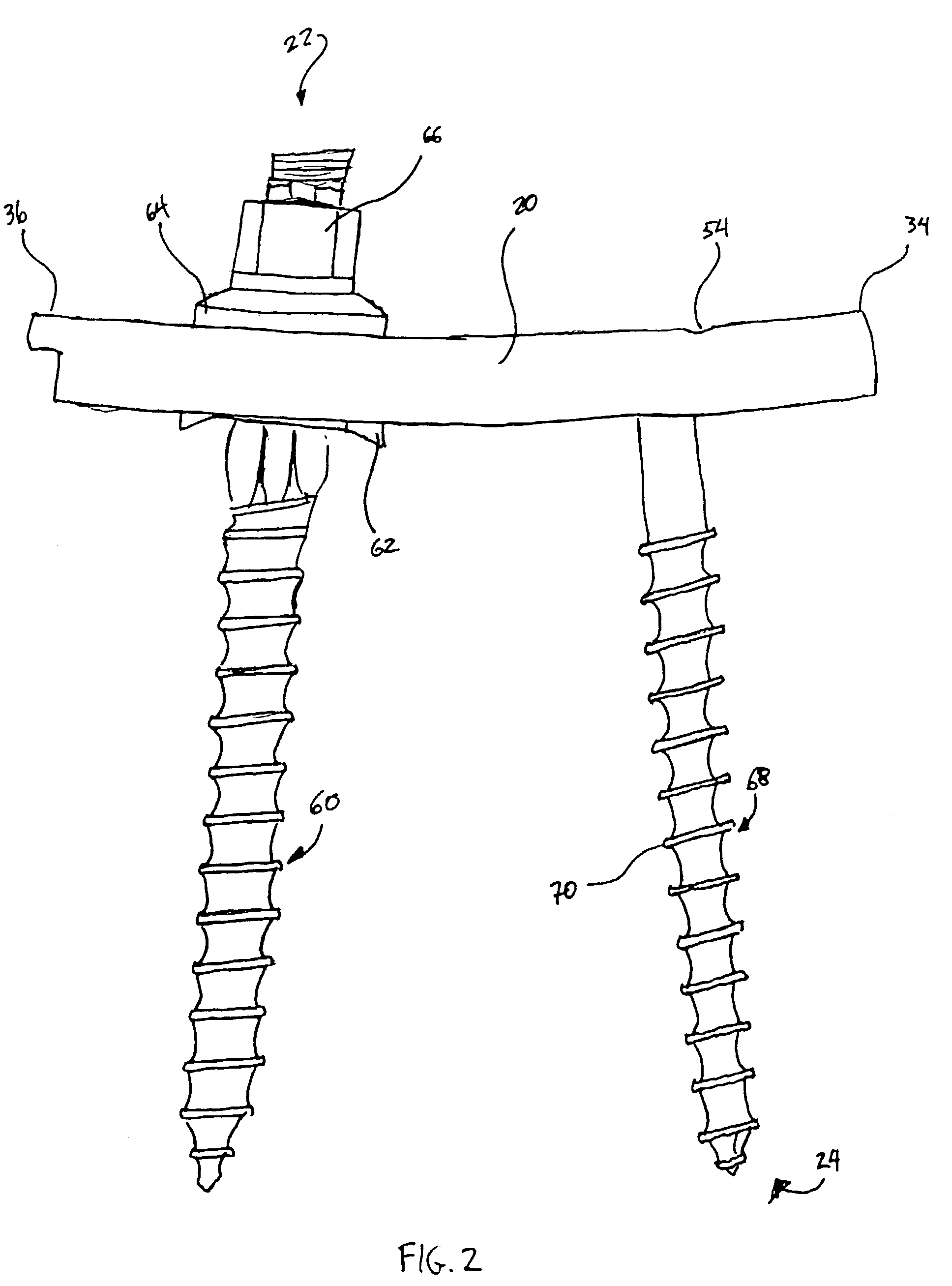 Posterior pedicle screw and plate system and methods