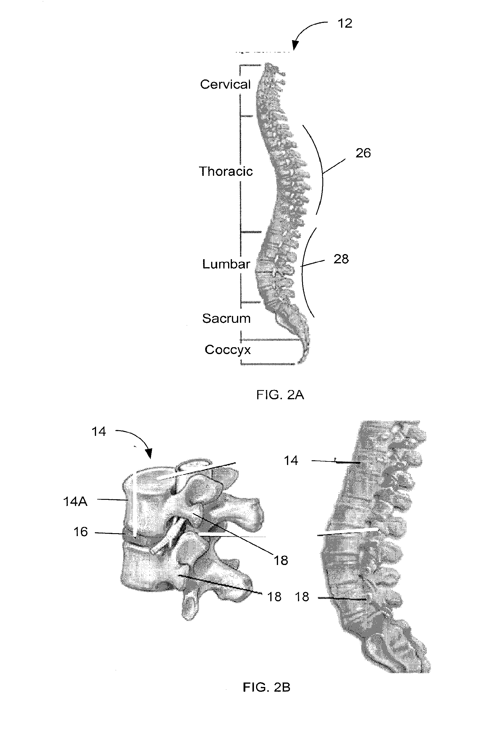 System and methods for correcting spinal deformities