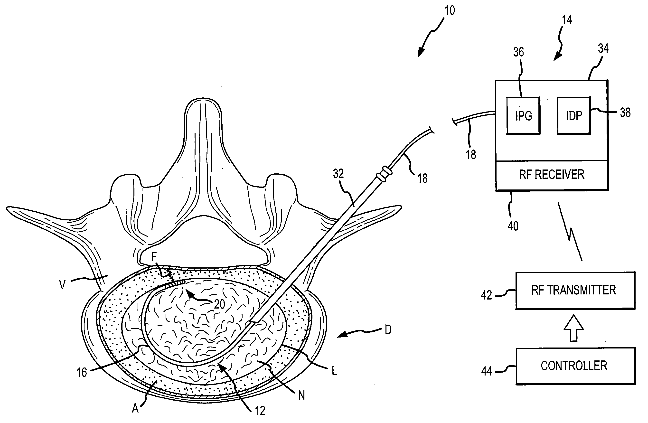 Combination electrical stimulating and infusion medical device and method