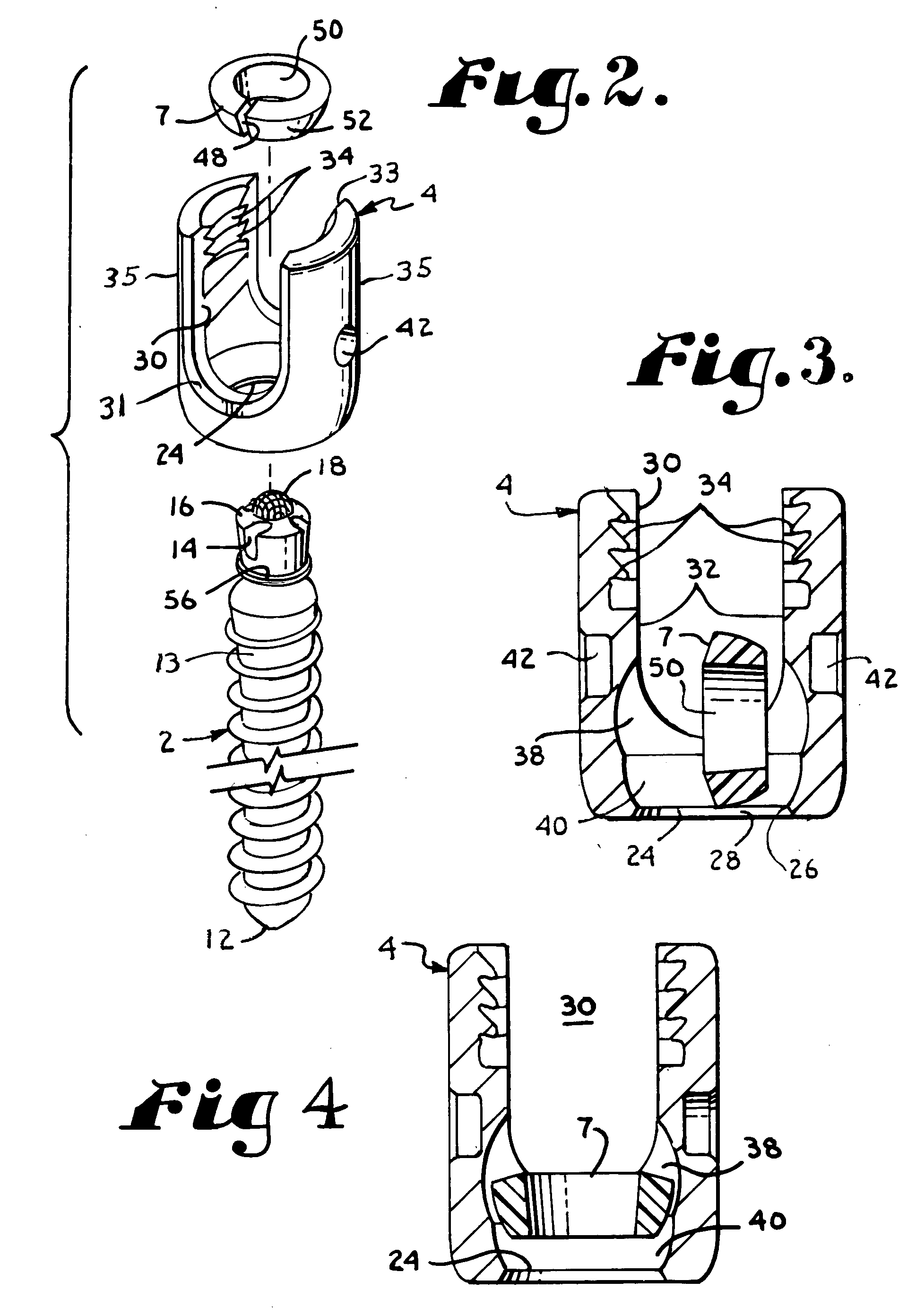 Polyaxial bone screw with split retainer ring