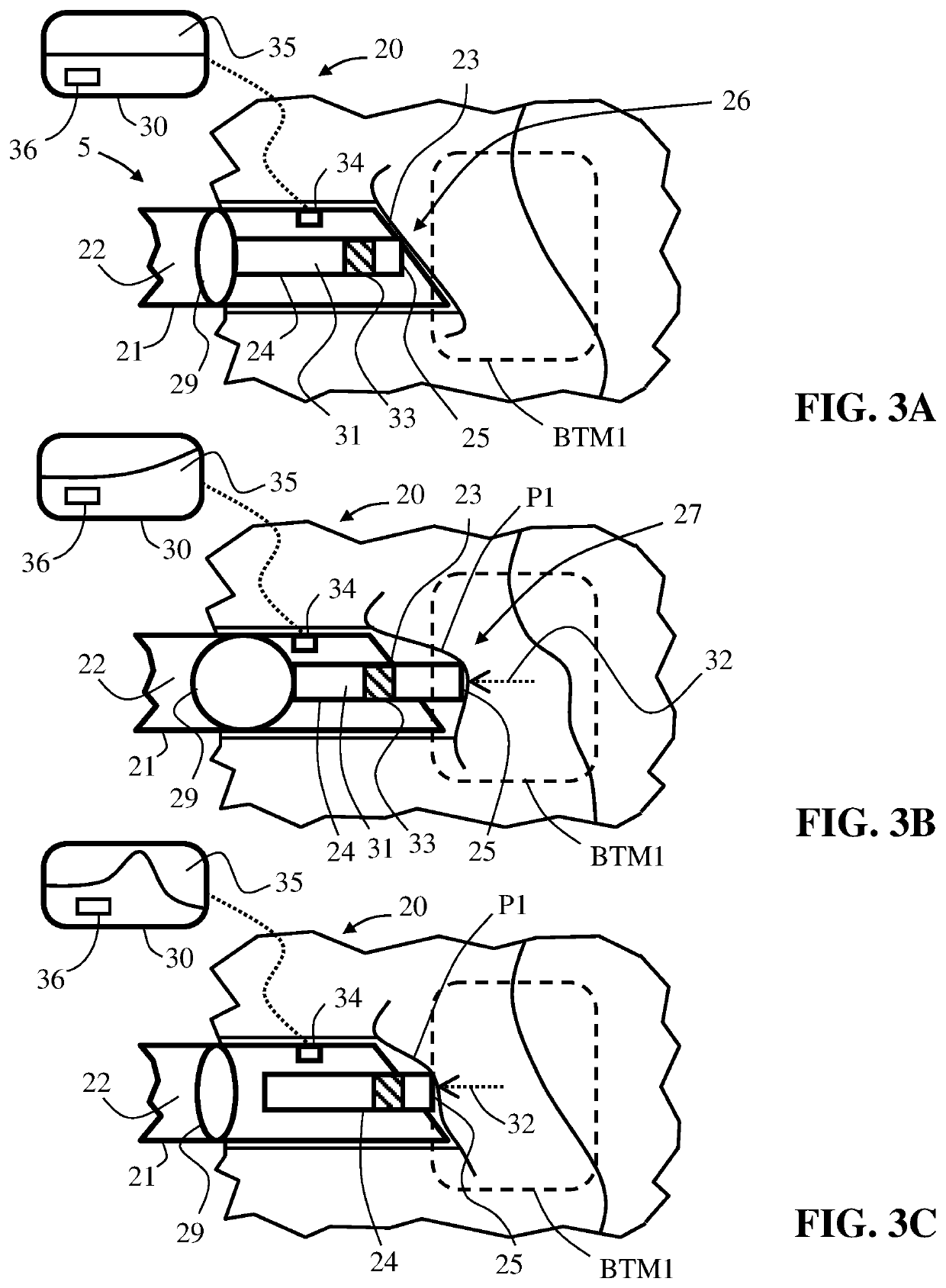 Identifying a target anatomic location in a subject's body, and delivering a medicinal substance thereto