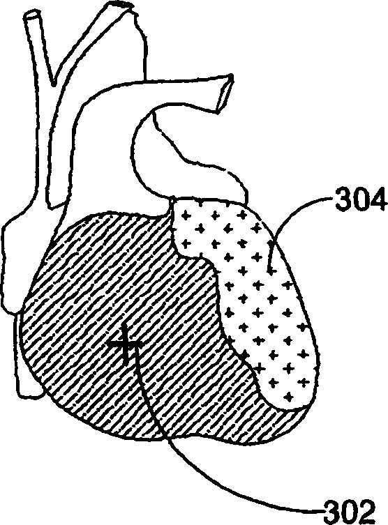 Ischemia identification, quantification and partial localization in MCG