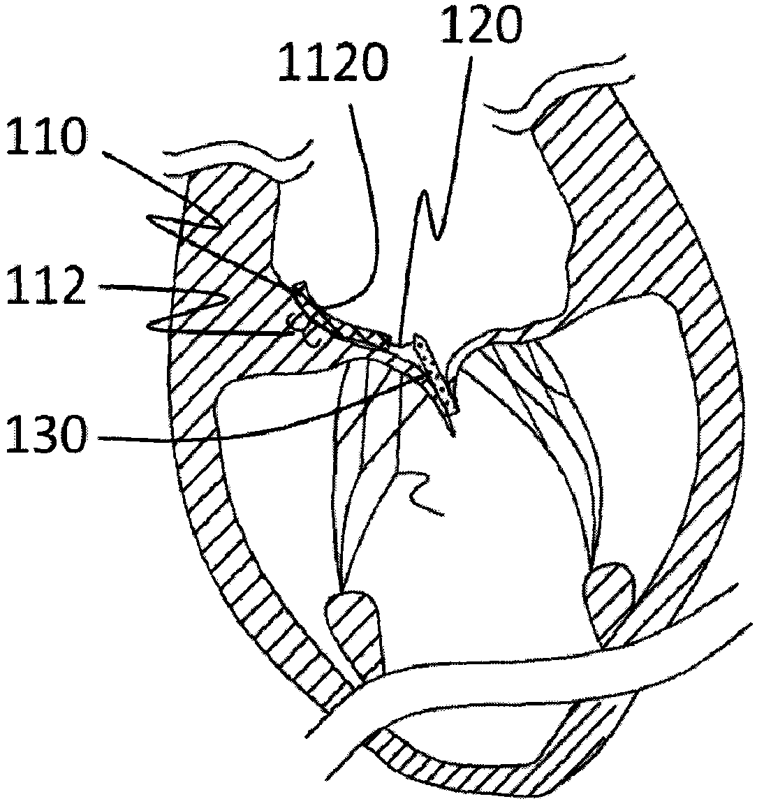 Prosthesis used for preventing valve reflux