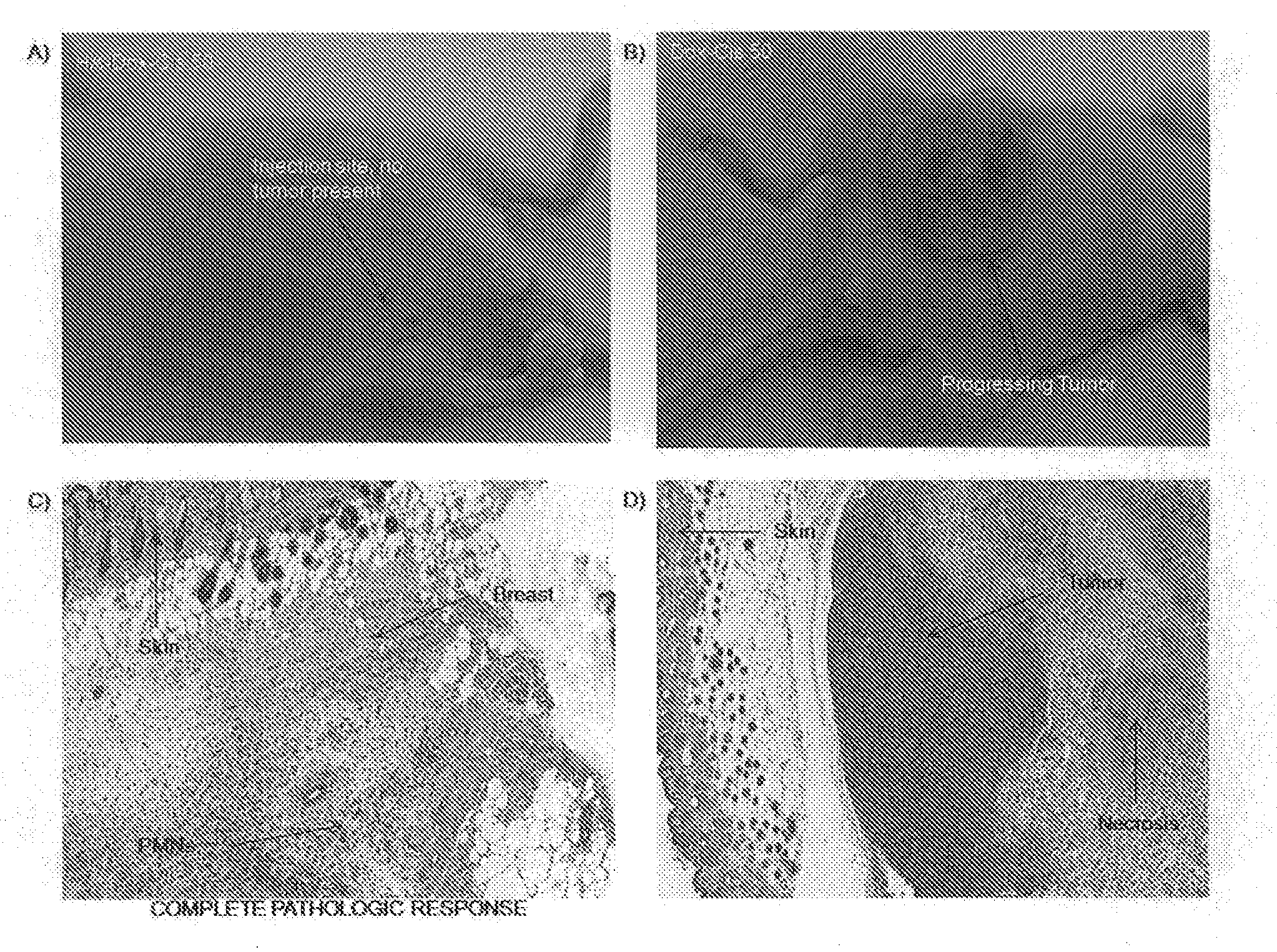 Intralymphatic Chemotherapy Drug Carriers