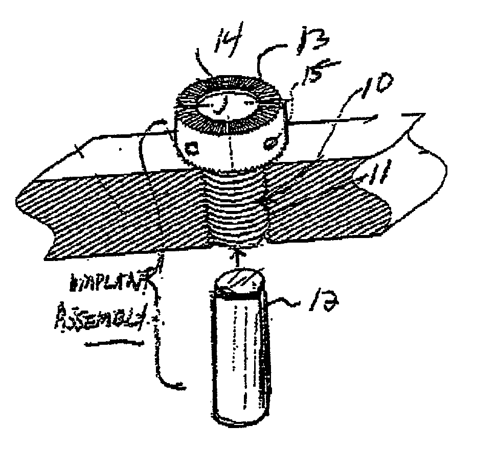 Technique for installing dental implant assembly