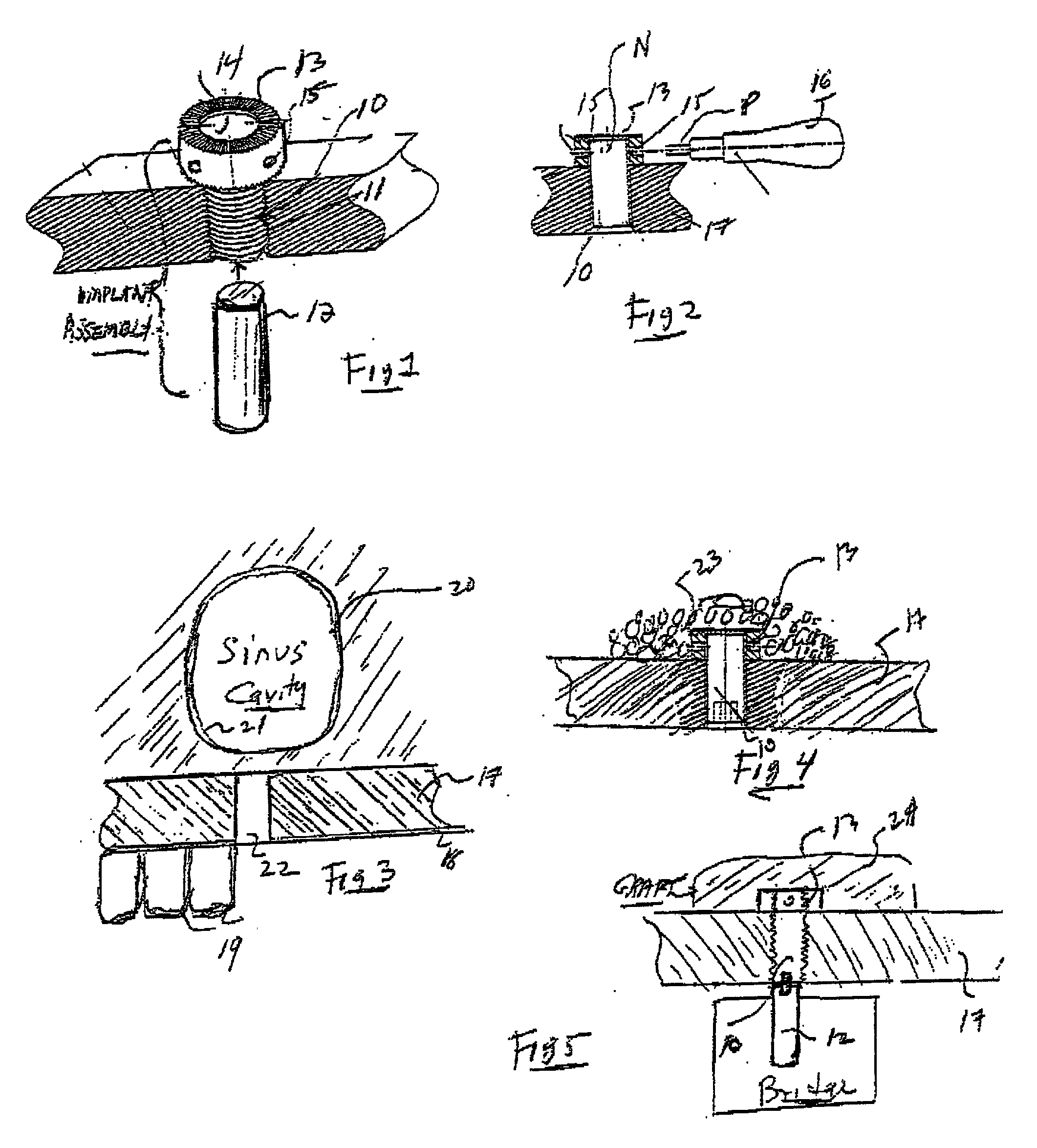 Technique for installing dental implant assembly