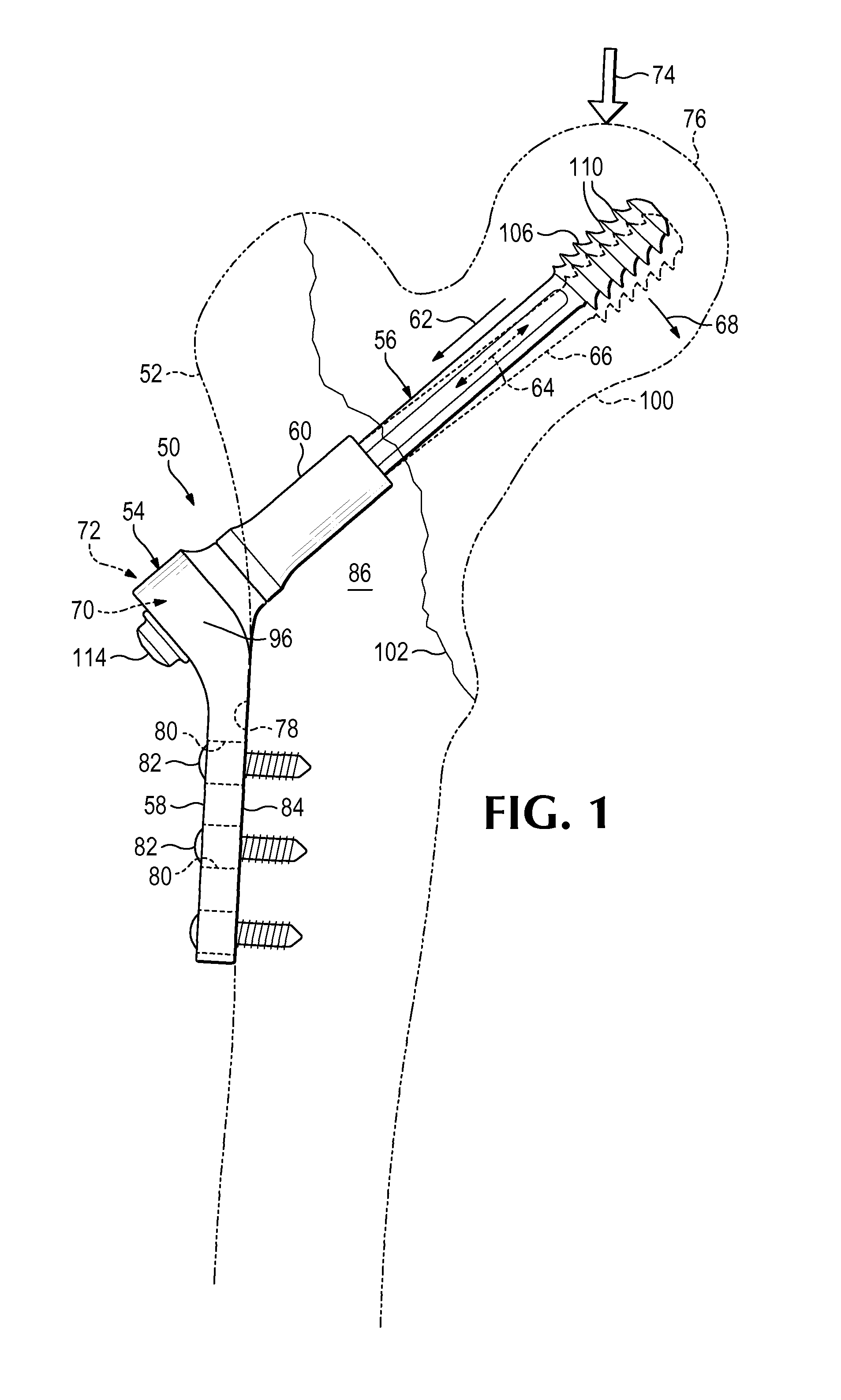 Plate-based compliant hip fixation system