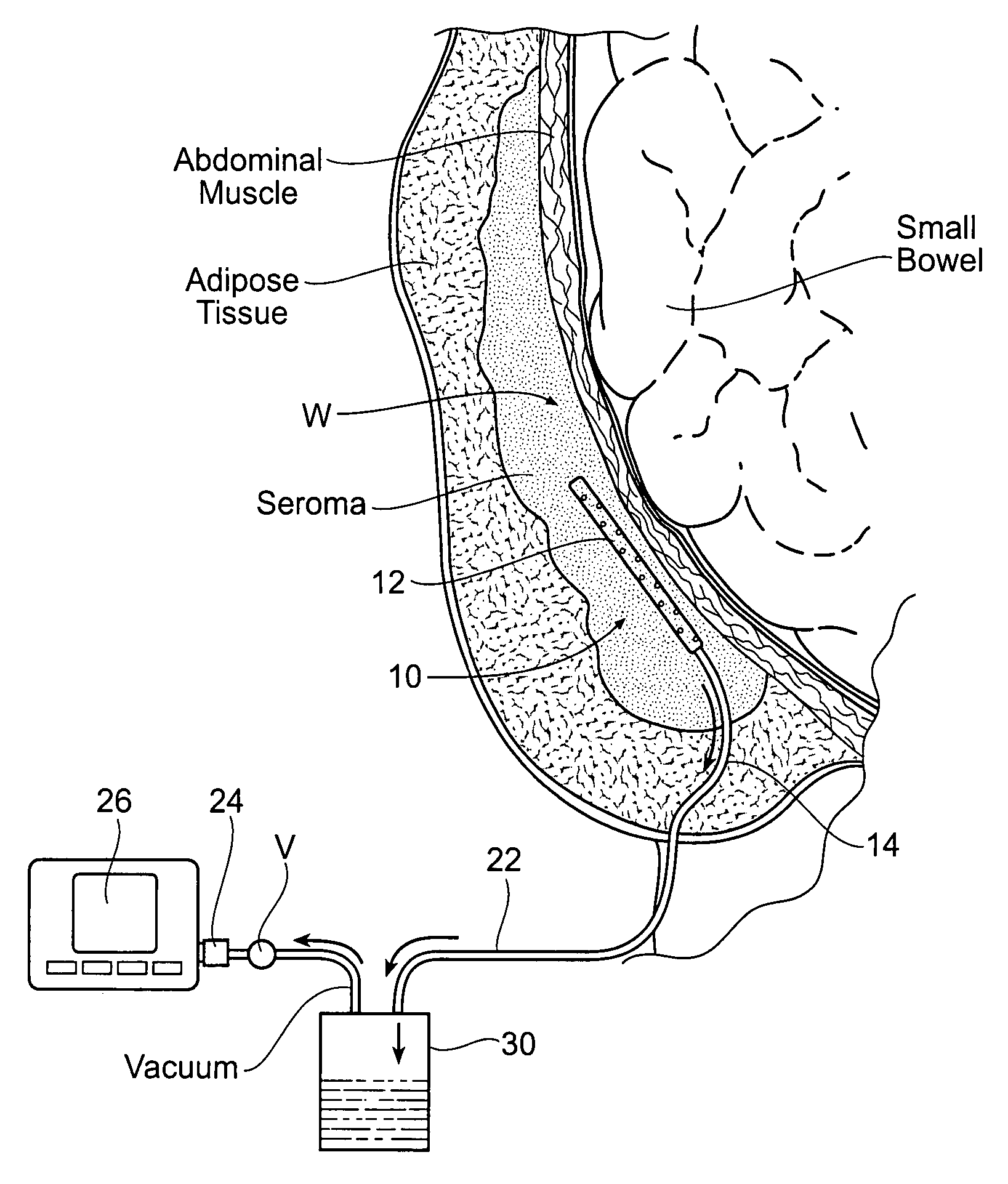 Assemblies, systems, and methods for vacuum assisted internal drainage during wound healing