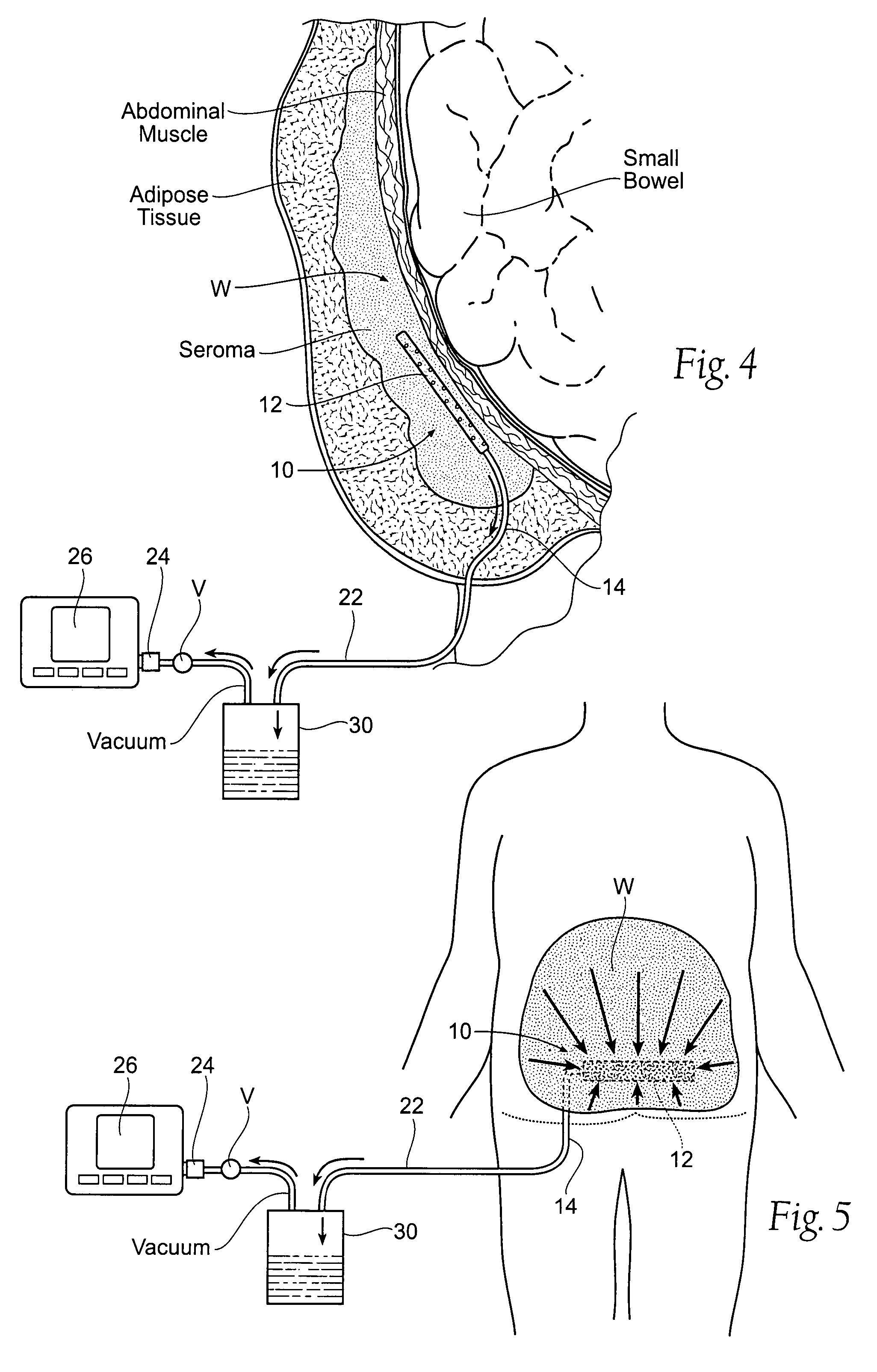 Assemblies, systems, and methods for vacuum assisted internal drainage during wound healing