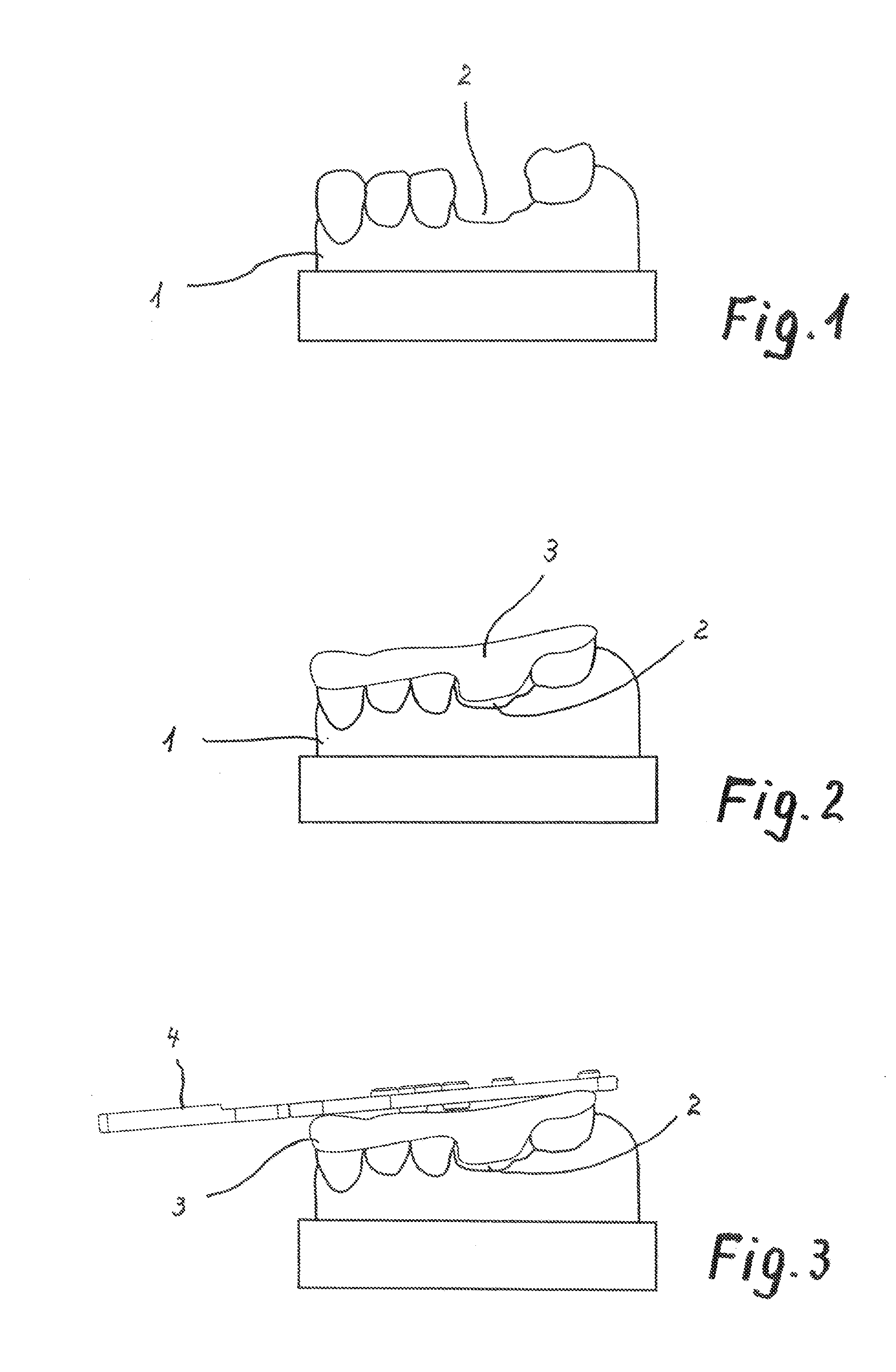 Method For Producing Individual Drilling Templates For Dental Implant Surgery In A Patient's Jawbone