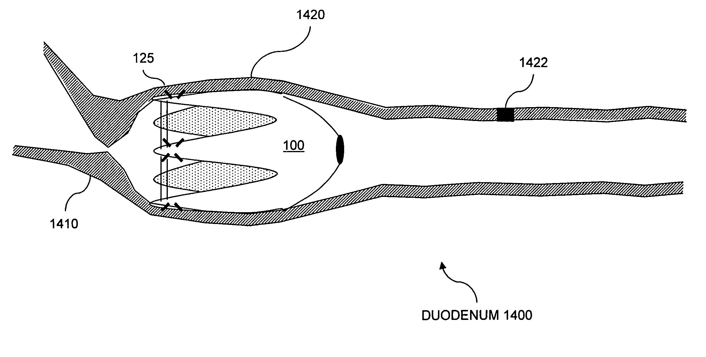 Resistive anti-obesity devices