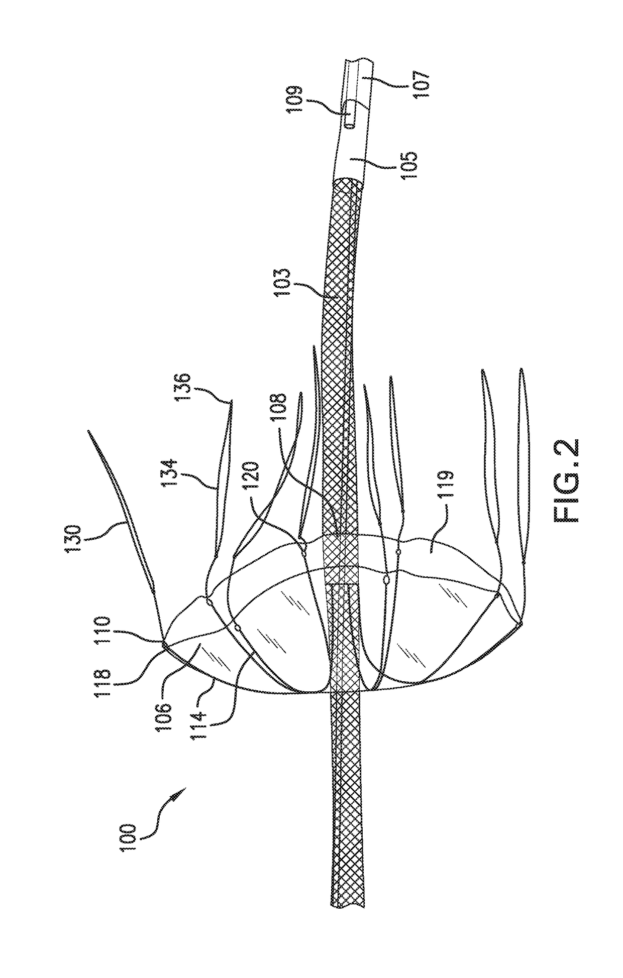 Inverting Temporary Valve Sheath