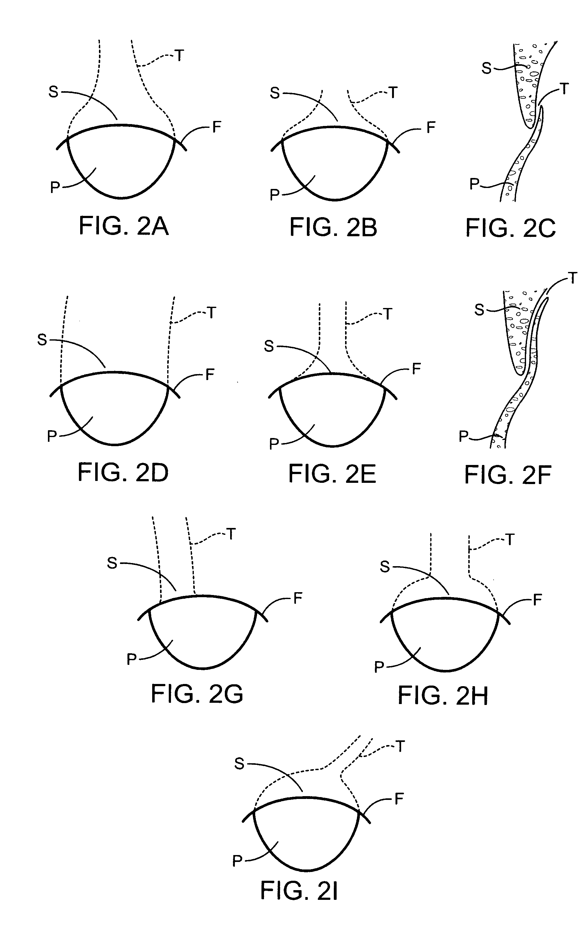 Methods and electrode apparatus to achieve a closure of a layered tissue defect