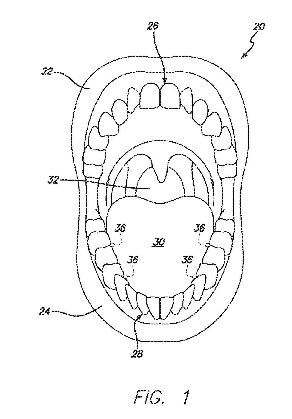 Dental Sleep Apnea Device