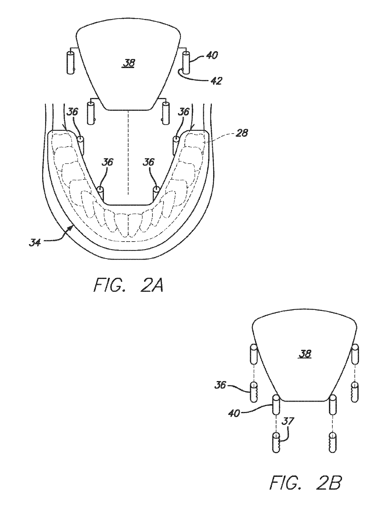 Dental Sleep Apnea Device