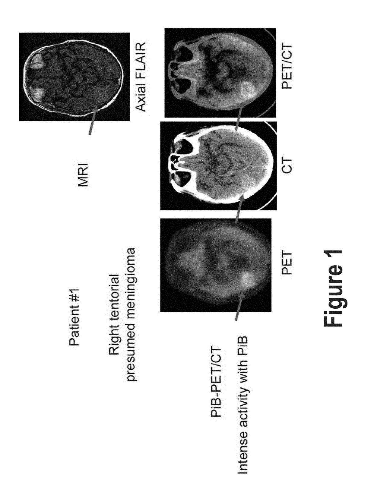 Treatment of Meningiomas Using Phenylbenzothiazole, Stilbene, Biphenylalkyne, or Pyridine Derivitives