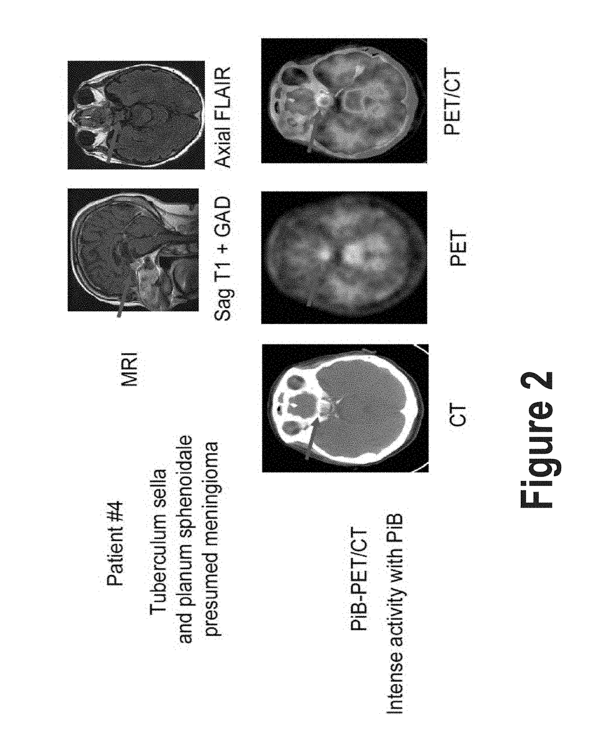 Treatment of Meningiomas Using Phenylbenzothiazole, Stilbene, Biphenylalkyne, or Pyridine Derivitives