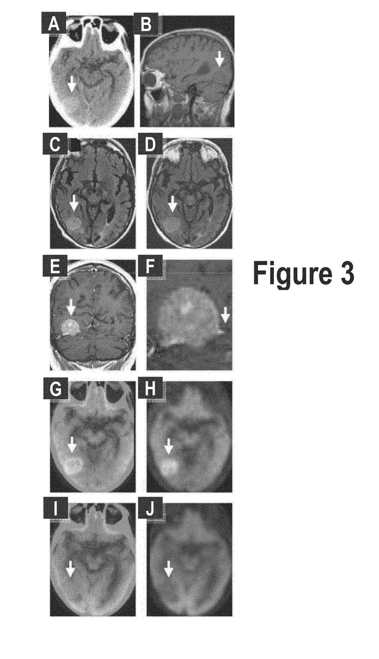 Treatment of Meningiomas Using Phenylbenzothiazole, Stilbene, Biphenylalkyne, or Pyridine Derivitives