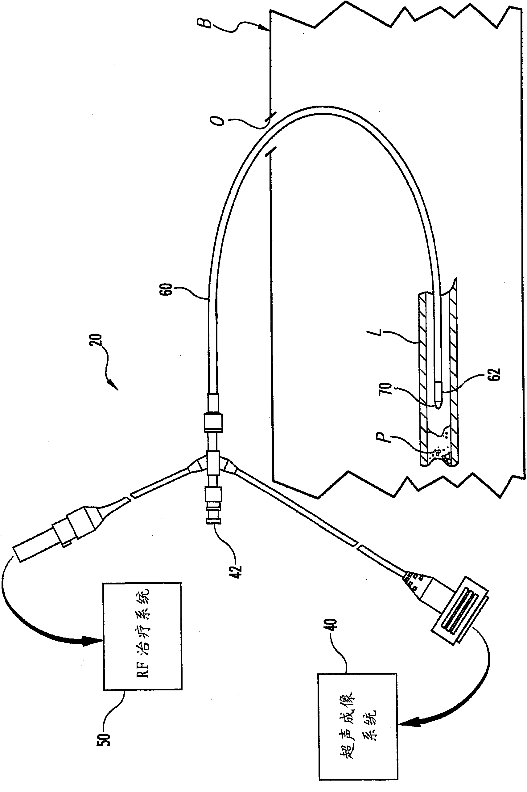 Image-guided intravascular therapy catheters